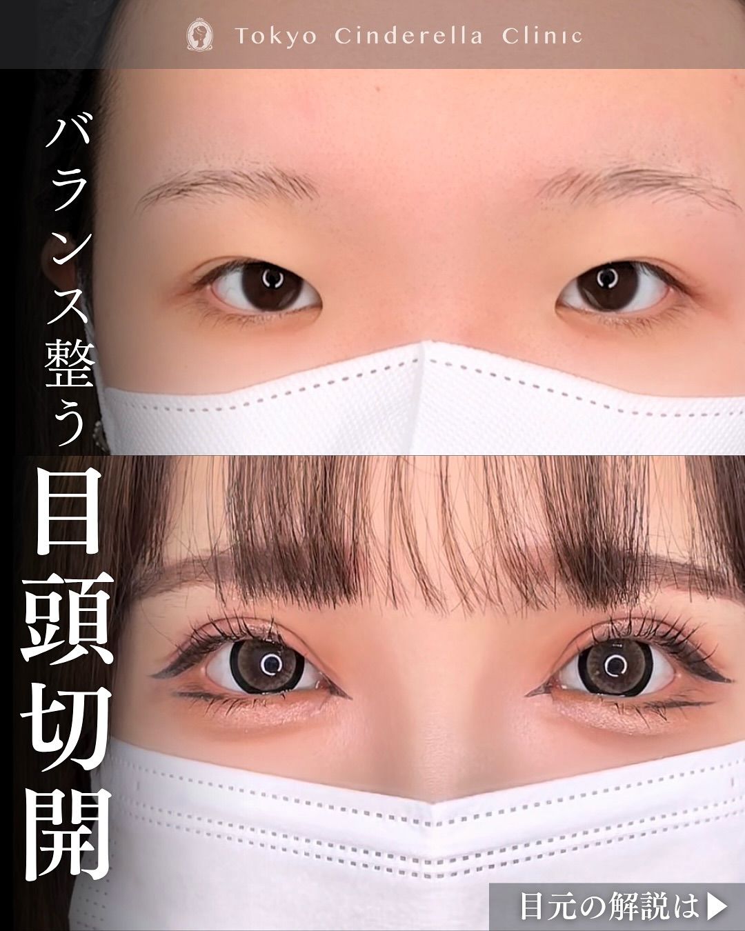 新宿院で行った二重整形で有名な吉原伯医師のMD式のたるみ取り併用全切開法二重術と眼瞼下垂手術と目頭切開の2週間後の症例写真