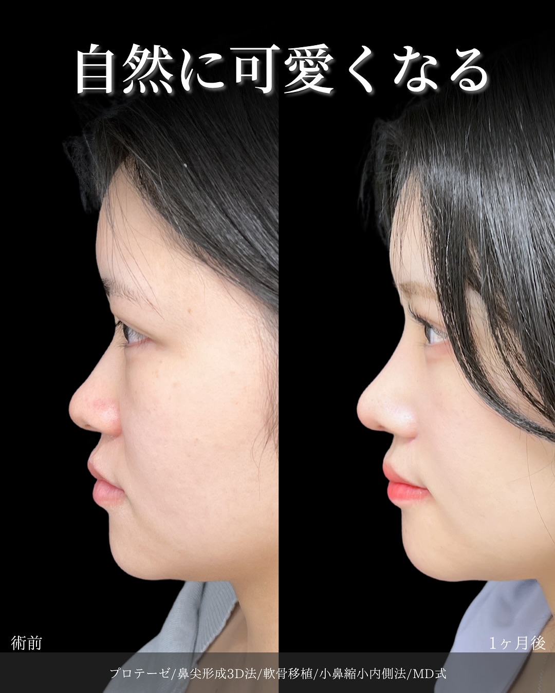 新宿院で行った鼻整形の名医の吉原伯医師のMD式のプロテーゼと鼻尖形成3D法と軟骨移植と小鼻縮小内側法の症例写真