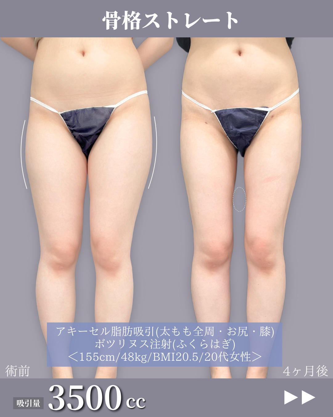 新宿院で行ったアキーセル脂肪吸引(太もも全周・お尻・膝)とボツリヌス注射(ふくらはぎ)の名医の吉原伯医師の症例写真