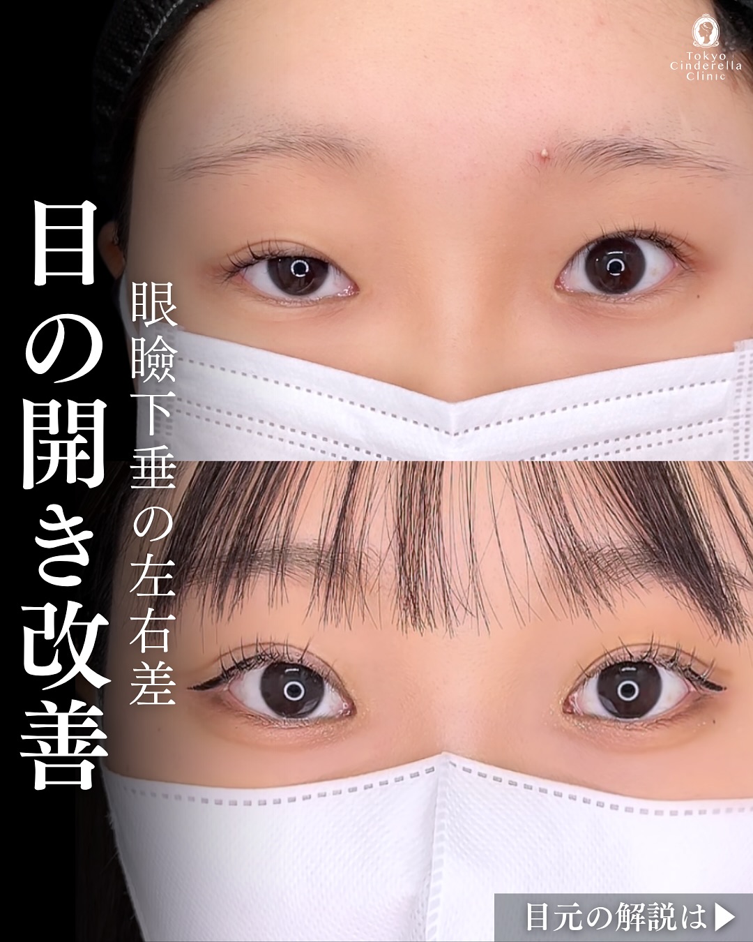新宿院で行った二重整形で有名な吉原伯医師のMD式のたるみ取り併用全切開法二重術と眼瞼下垂手術と埋没法抜糸の6ヶ月後の症例写真