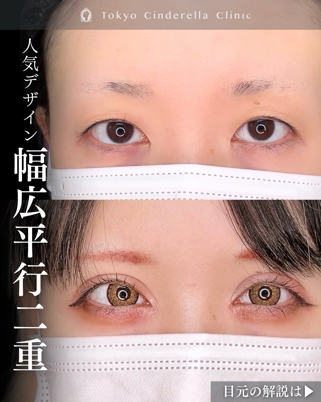 新宿院で行った二重整形で有名な吉原伯医師のMD式のたるみ取り併用全切開法二重術と眼瞼下垂手術と他院修正の3ヶ月後の症例写真