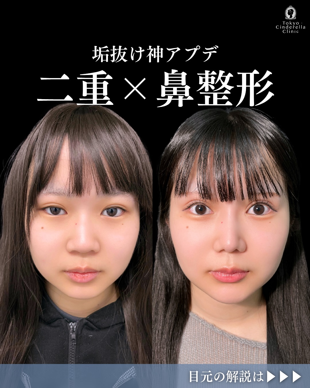 新宿院で行った二重整形と鼻整形で有名な吉原伯医師のMD式のたるみ取り併用全切開法二重術と眼瞼下垂手術と目頭切開と目尻切開とタレ目形成(結膜切開)と埋没法抜糸とオーダーメイドプロテーゼと鼻尖形成3D法と軟骨移植と鼻中隔延長と鼻柱下降術とわし鼻削りと斜鼻修正と小鼻縮小内側法の3ヶ月後の症例写真