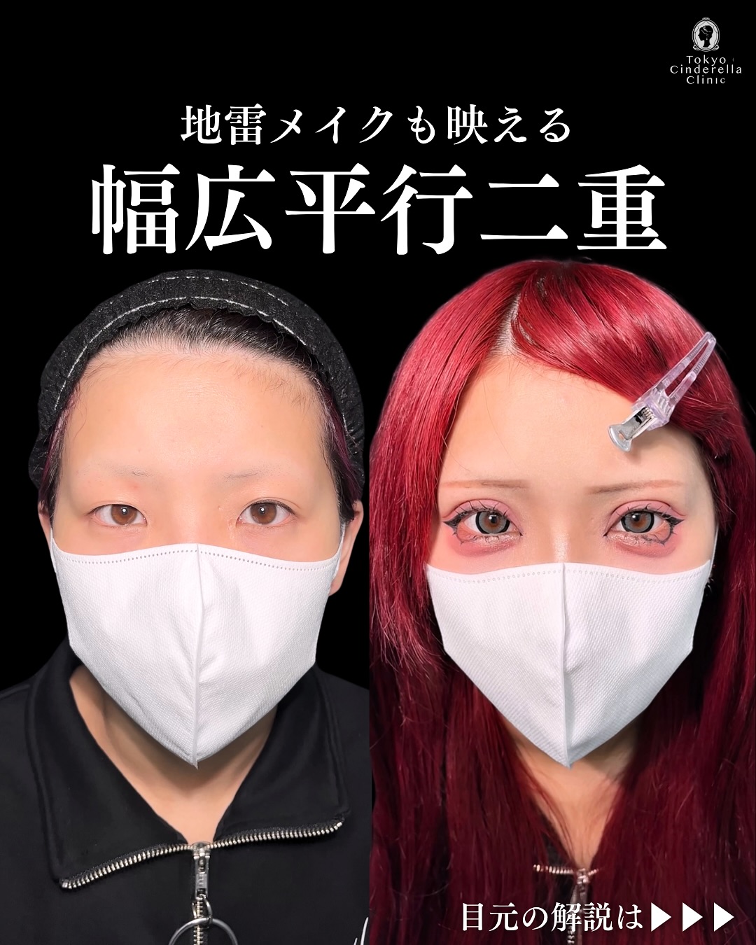 新宿院で行った二重整形で有名な吉原伯医師のMD式のたるみ取り併用全切開法二重術と眼瞼下垂手術と目頭切開と埋没法抜糸の2週間後の症例写真