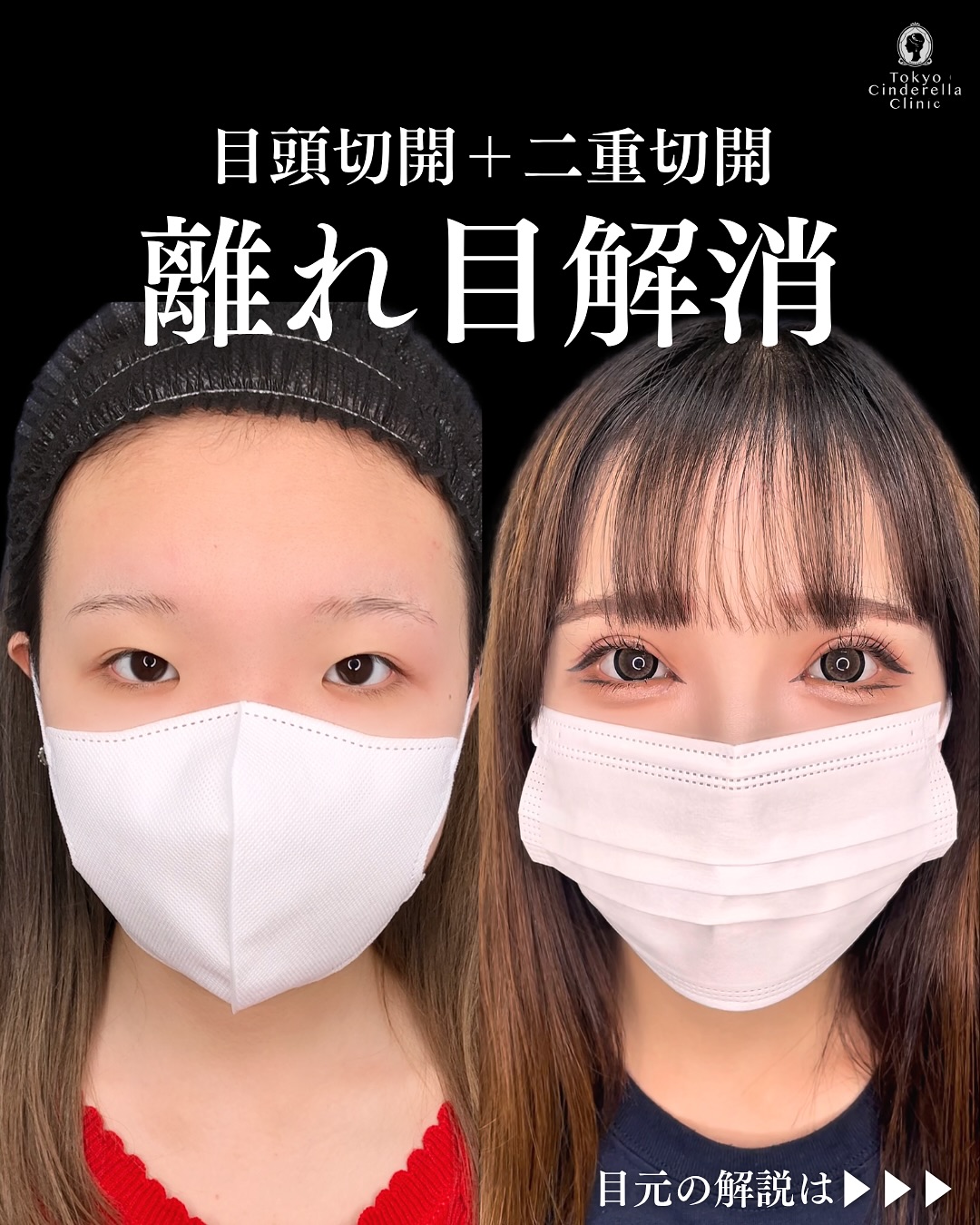 新宿院で行った二重整形で有名な吉原伯医師のMD式のたるみ取り併用全切開法二重術と眼瞼下垂手術と目頭切開の2週間後の症例写真