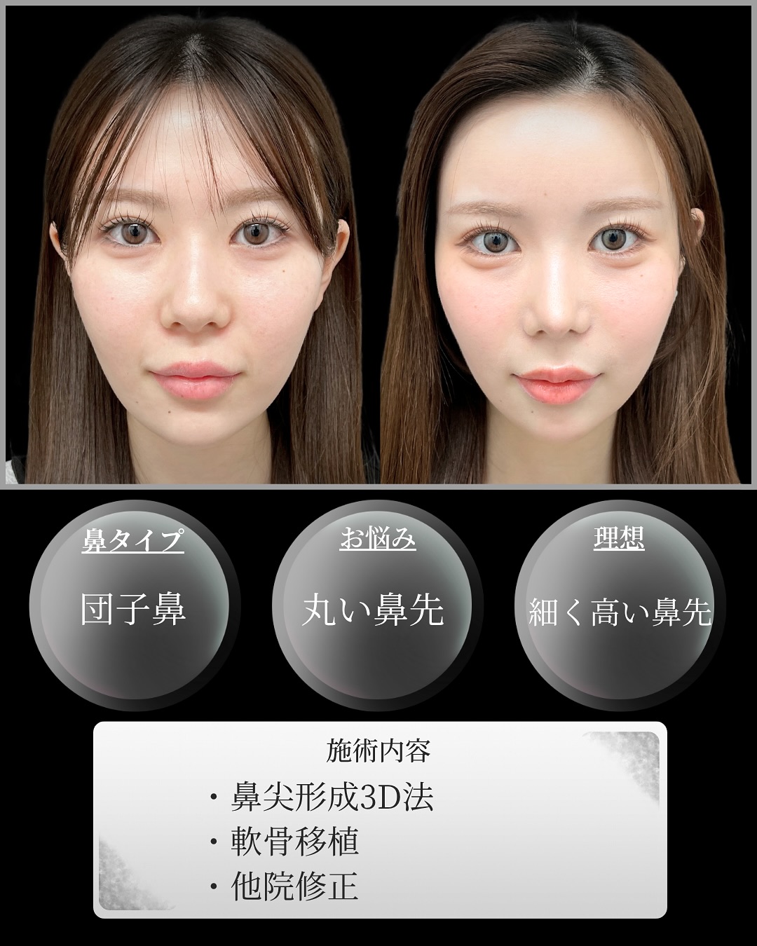 新宿院で行った鼻整形の名医の吉原伯医師のMD式の鼻尖形成3D法と軟骨移植と他院修正の症例写真