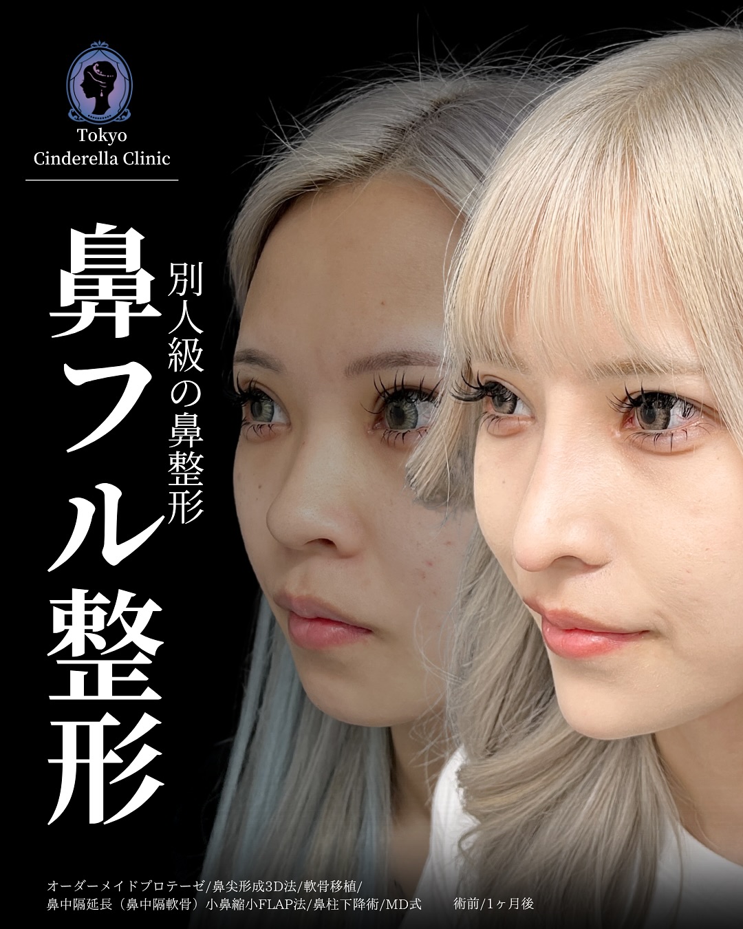 新宿院で行ったMD式のオーダーメイドプロテーゼと鼻尖形成3D法と軟骨移植と鼻中隔延長(鼻中隔軟骨)と小鼻縮小FLAP法と鼻柱下降術の名医の吉原伯医師の症例写真