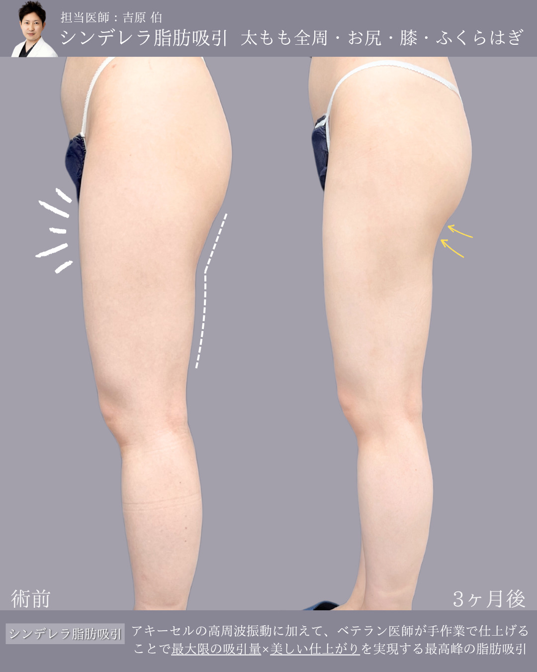 新宿院で行ったシンデレラ脂肪吸引(太もも全周・お尻・膝・ふくらはぎ)の名医の吉原伯医師の症例写真