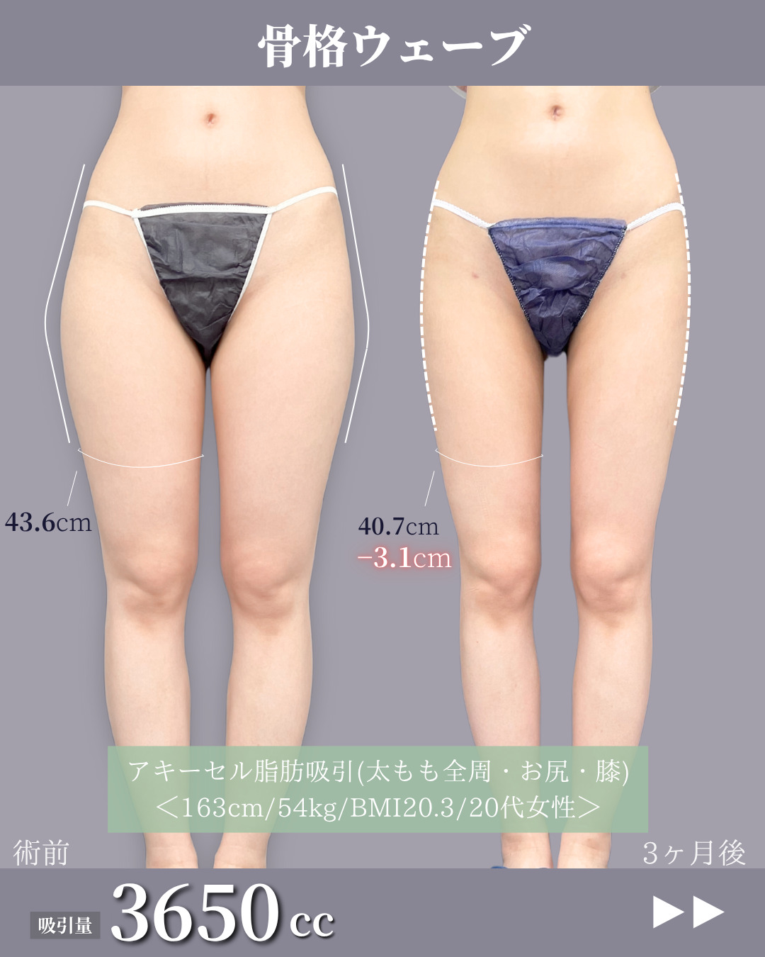 新宿院で行ったアキーセル脂肪吸引(太もも全周・お尻・膝)の名医の吉原伯医師の症例写真