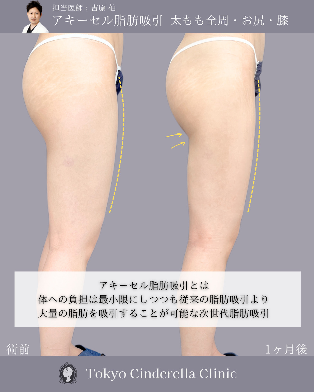 新宿院で行ったアキーセル脂肪吸引(太もも全周・お尻・膝)の名医の吉原伯医師の症例写真