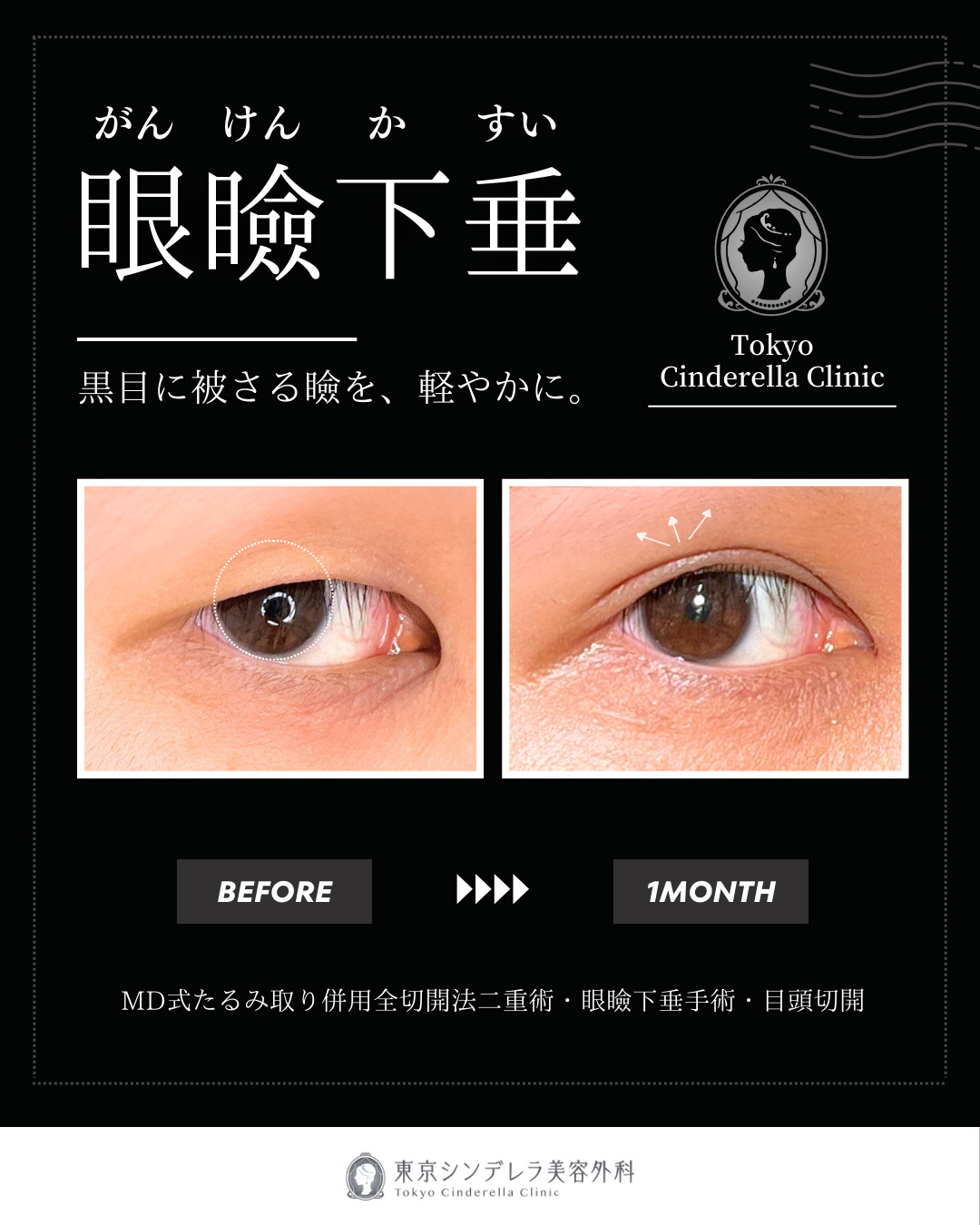 大宮院で行った二重整形の竹田昌平医師の症例写真