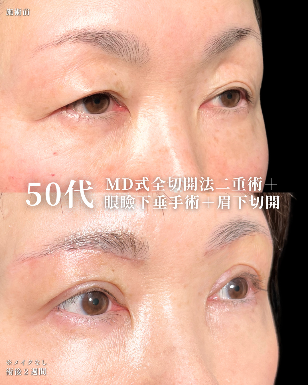 大宮院で行った二重整形の竹田昌平医師の症例写真