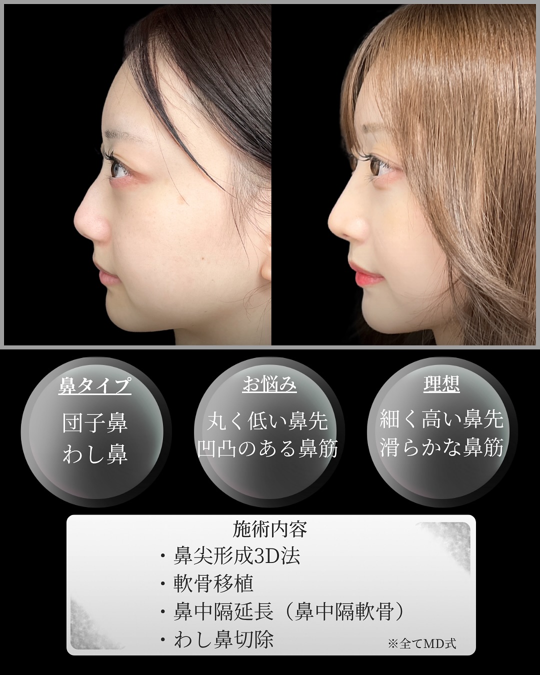 新宿院で行った鼻整形の名医の吉原伯医師のMD式の鼻尖形成3D法の軟骨移植の鼻中隔延長(鼻中隔軟骨)のわし鼻切除の症例写真