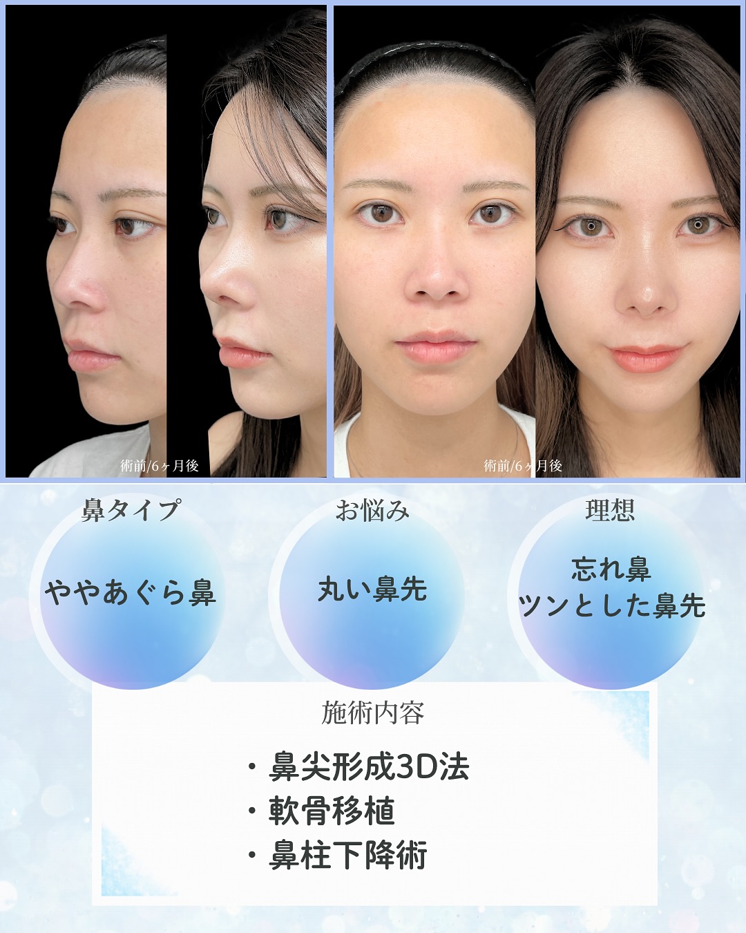 新宿院で行った鼻整形の名医の吉原伯医師のMD式のたるみ取り併用全切開法二重術と眼瞼下垂手術と目頭切開と他院修正の症例写真