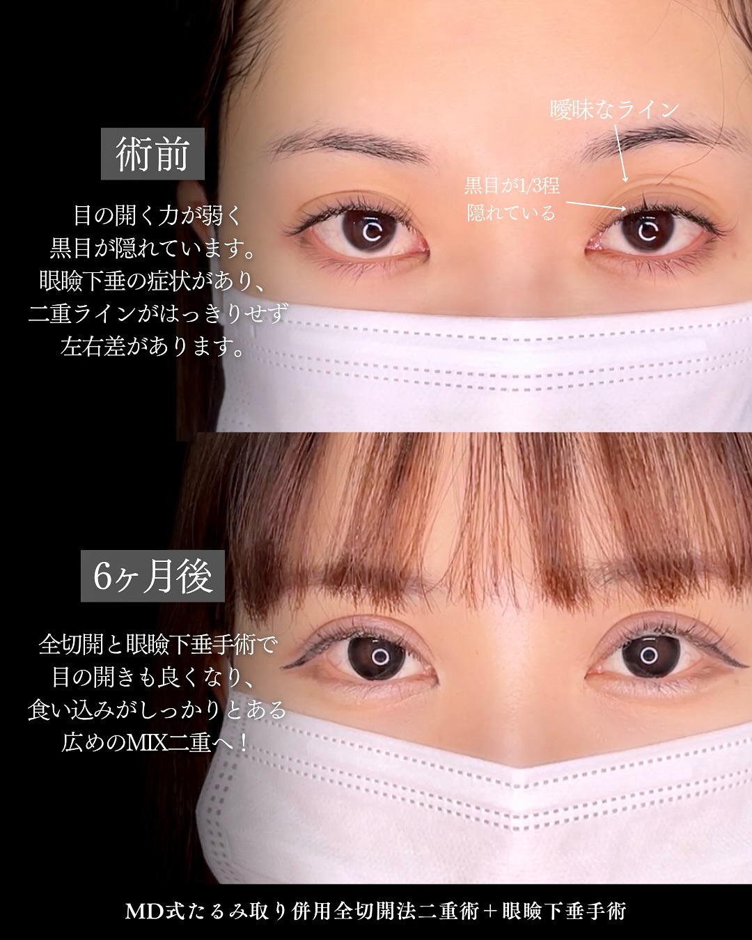 新宿院で行った二重整形で有名な吉原伯医師のMD式のたるみ取り併用全切開法二重術と眼瞼下垂手術の6ヶ月後の症例写真
