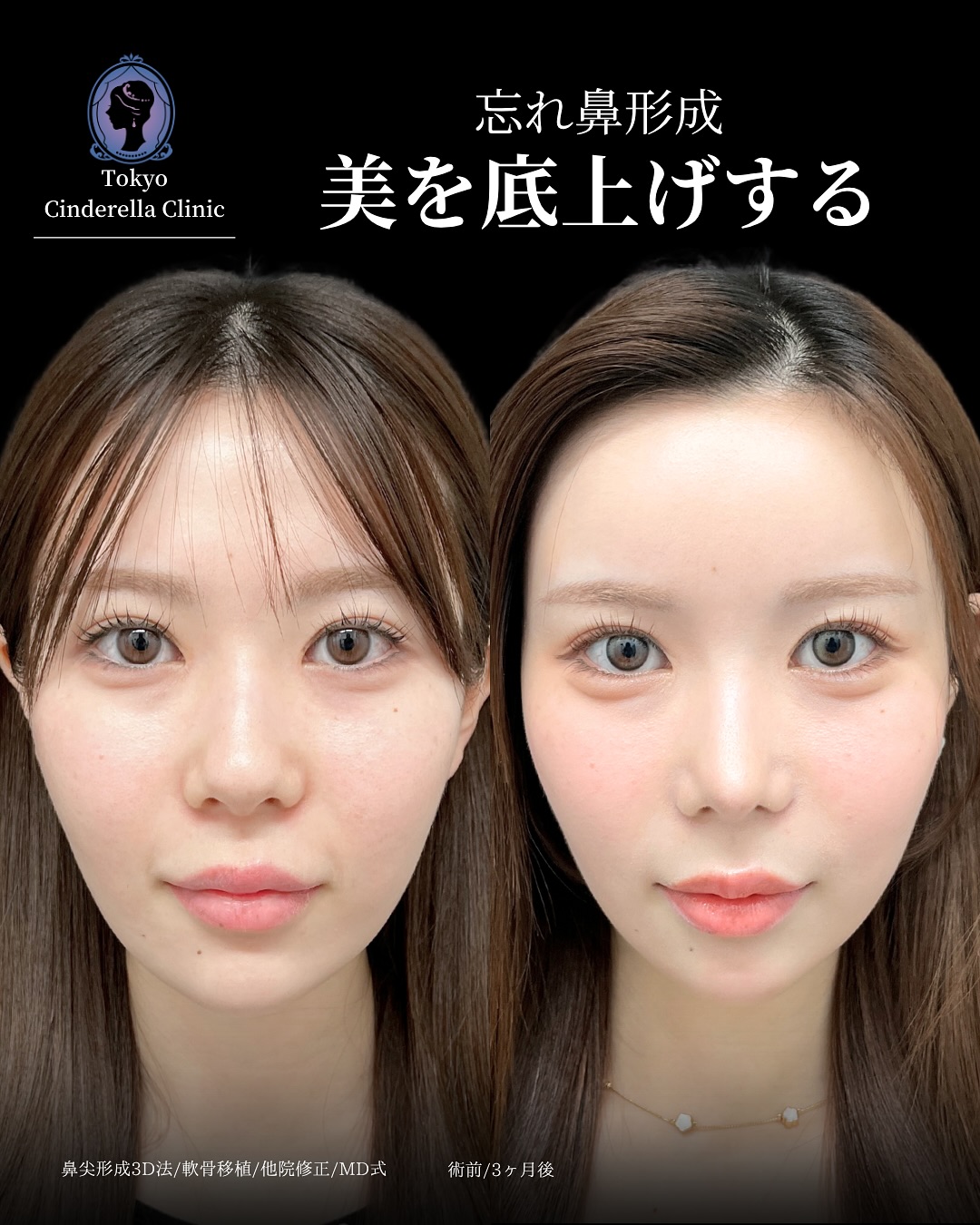新宿院で行った鼻整形の名医の吉原伯医師のMD式の鼻尖形成3D法と軟骨移植と他院修正の症例写真