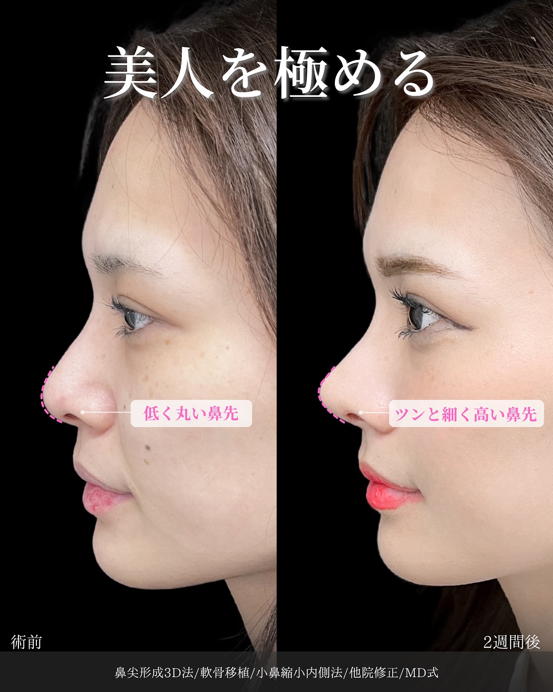 新宿院で行った鼻整形の名医の吉原伯医師のMD式の鼻尖形成3D法と軟骨移植と小鼻縮小内側法と他院修正の症例写真