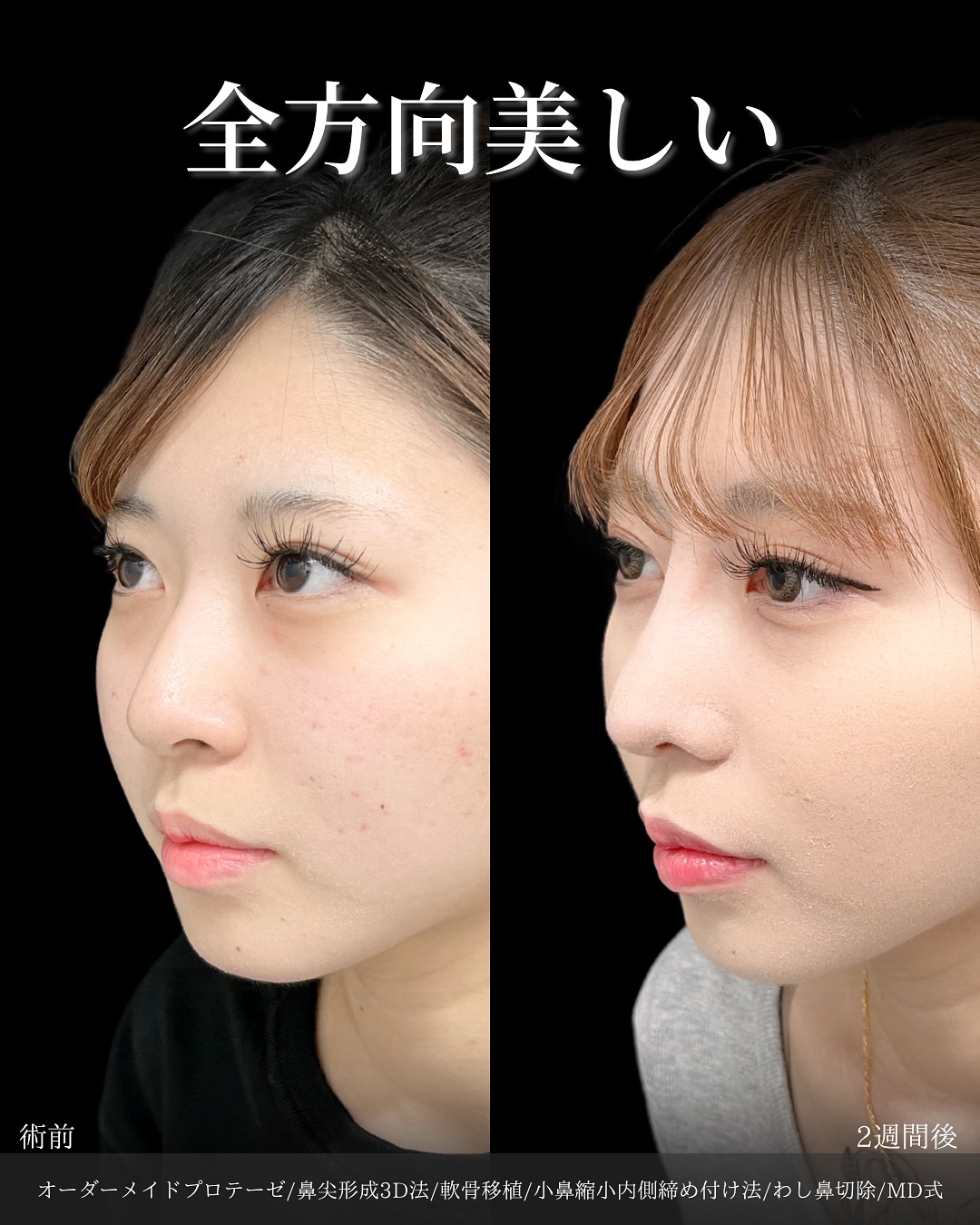 新宿院で行った鼻整形の名医の吉原伯医師のMD式のオーダーメイドプロテーゼと鼻尖形成3D法と軟骨移植と小鼻縮小内側締め付け法とわし鼻切除の症例写真