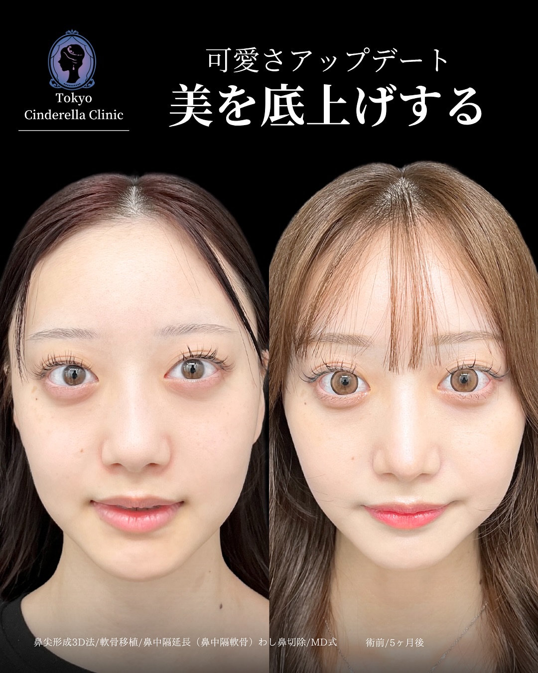 新宿院で行った鼻整形の名医の吉原伯医師のMD式の鼻尖形成3D法の軟骨移植の鼻中隔延長(鼻中隔軟骨)のわし鼻切除の症例写真
