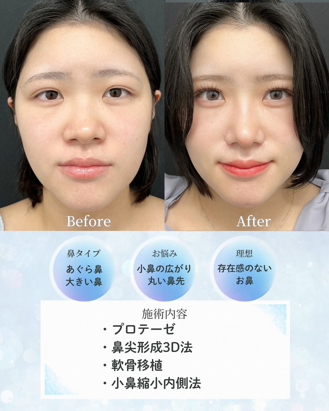 新宿院で行った鼻整形の名医の吉原伯医師のMD式のプロテーゼと鼻尖形成3D法と軟骨移植と小鼻縮小内側法の症例写真