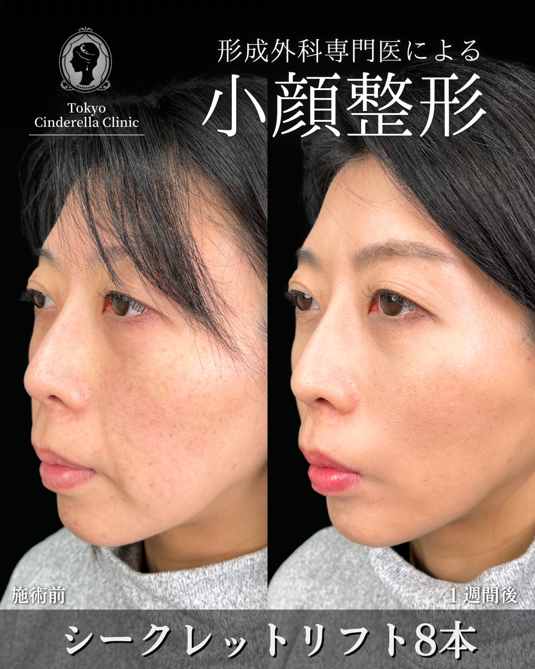 大宮院で行った小顔整形の竹田昌平医師の症例写真