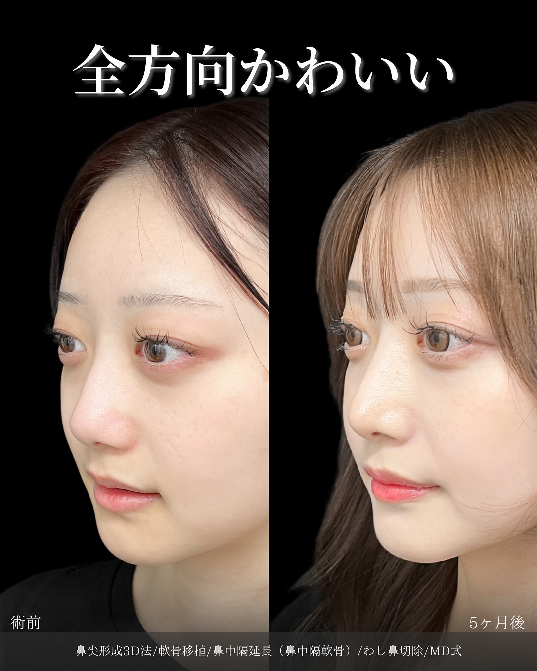 新宿院で行った鼻整形の名医の吉原伯医師のMD式の鼻尖形成3D法の軟骨移植の鼻中隔延長(鼻中隔軟骨)のわし鼻切除の症例写真