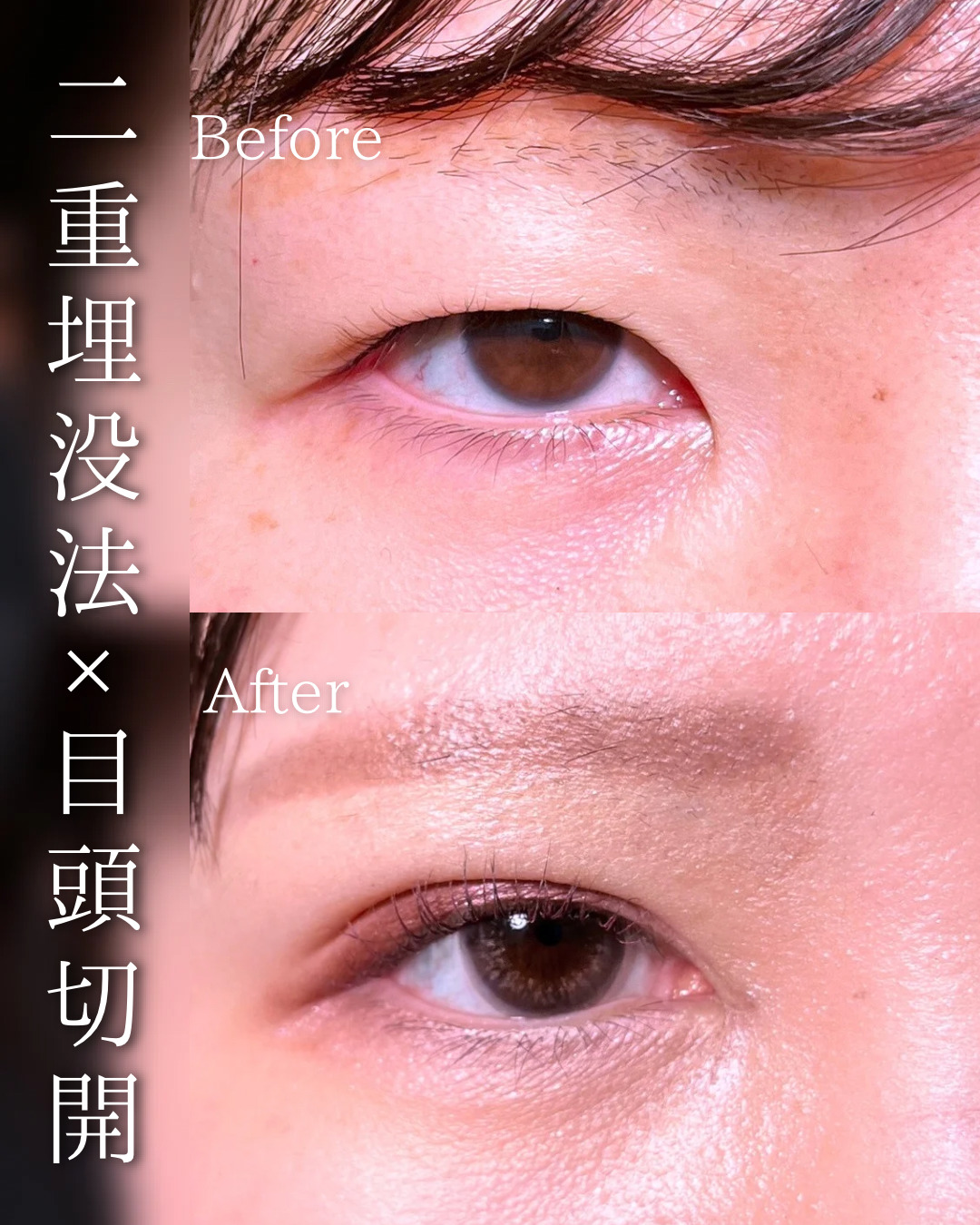 池袋院で行った二重整形と目頭切開の石井達也医師の症例写真