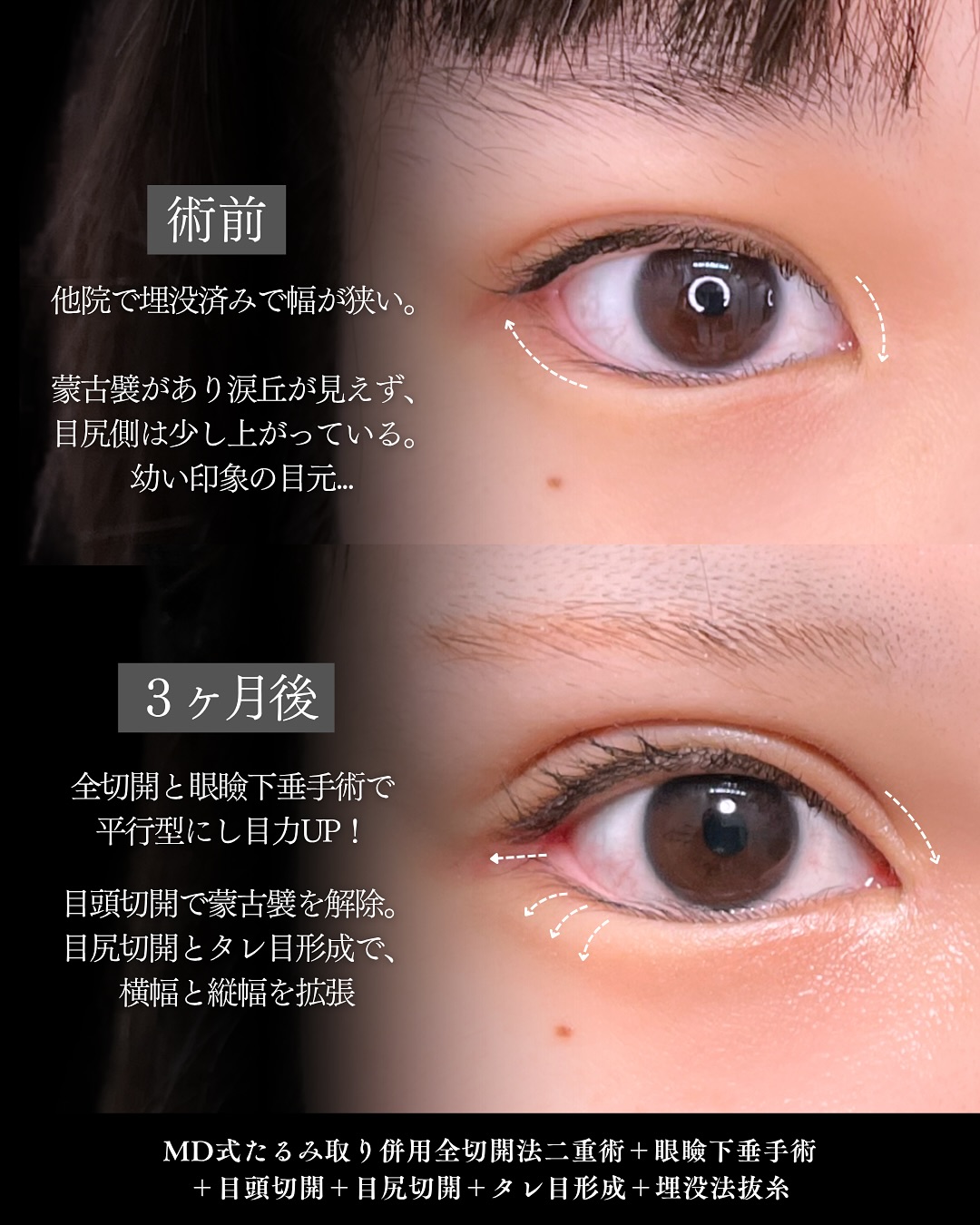 新宿院で行った二重整形と鼻整形で有名な吉原伯医師のMD式のたるみ取り併用全切開法二重術と眼瞼下垂手術と目頭切開と目尻切開とタレ目形成(結膜切開)と埋没法抜糸とオーダーメイドプロテーゼと鼻尖形成3D法と軟骨移植と鼻中隔延長と鼻柱下降術とわし鼻削りと斜鼻修正と小鼻縮小内側法の3ヶ月後の症例写真