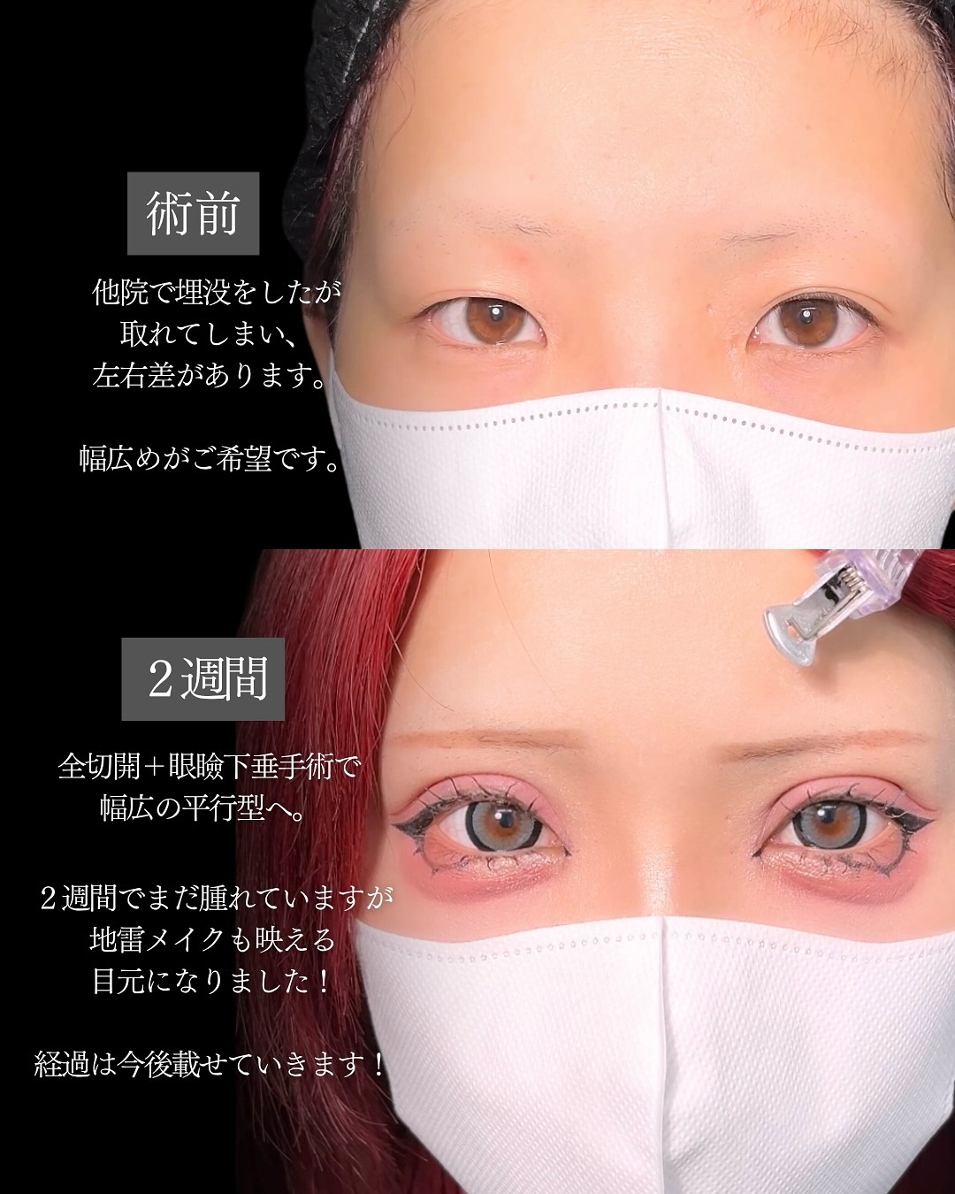 新宿院で行った二重整形で有名な吉原伯医師のMD式のたるみ取り併用全切開法二重術と眼瞼下垂手術と目頭切開と埋没法抜糸の2週間後の症例写真