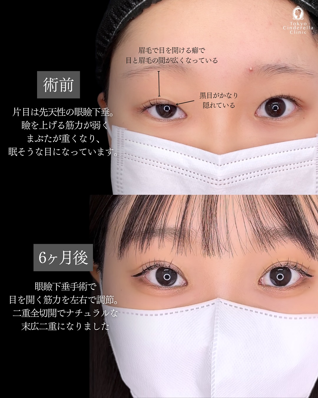 新宿院で行った二重整形で有名な吉原伯医師のMD式のたるみ取り併用全切開法二重術と眼瞼下垂手術と埋没法抜糸の6ヶ月後の症例写真