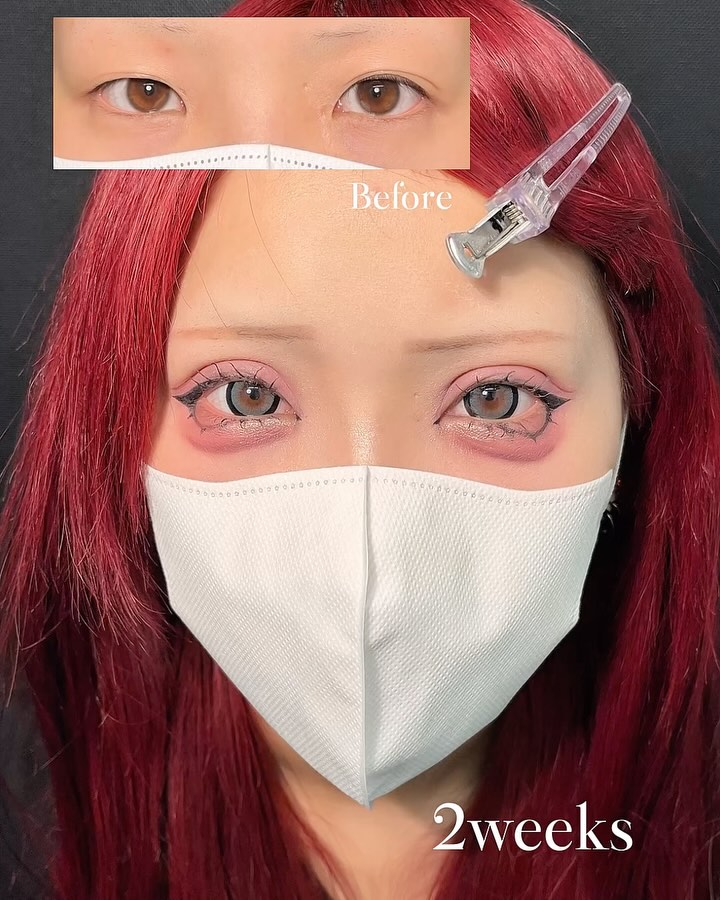 新宿院で行った二重整形で有名な吉原伯医師のMD式のたるみ取り併用全切開法二重術と眼瞼下垂手術と目頭切開と埋没法抜糸の2週間後の症例写真