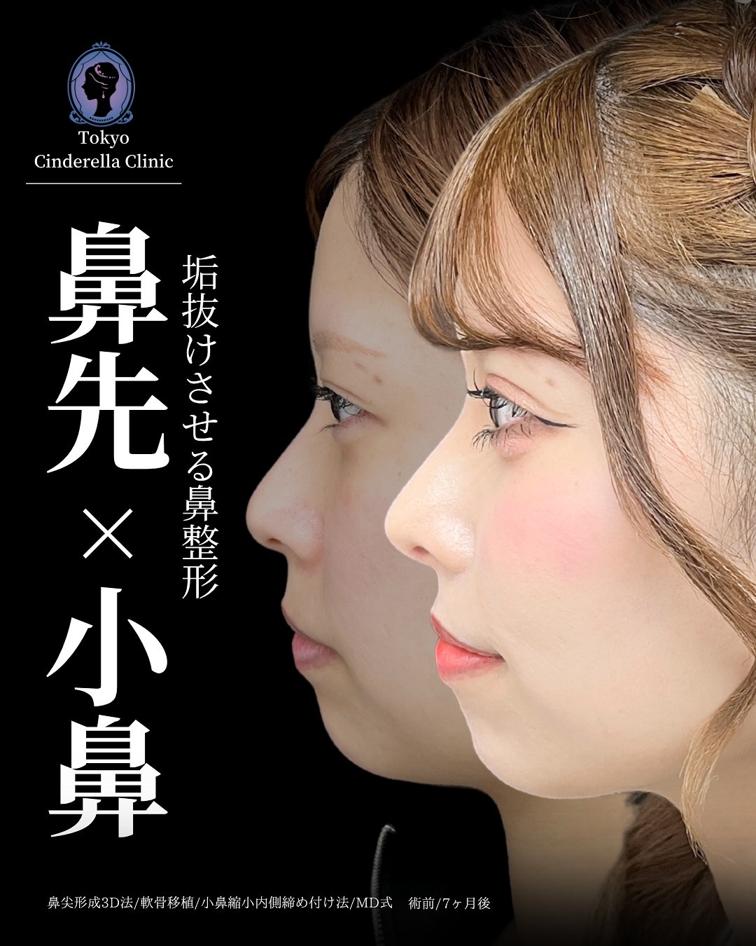 新宿院で行った鼻整形の名医の吉原伯医師のMD式の鼻尖形成3D法と軟骨移植と小鼻縮小内側締め付け法と韓国式自然癒着法6点の症例写真