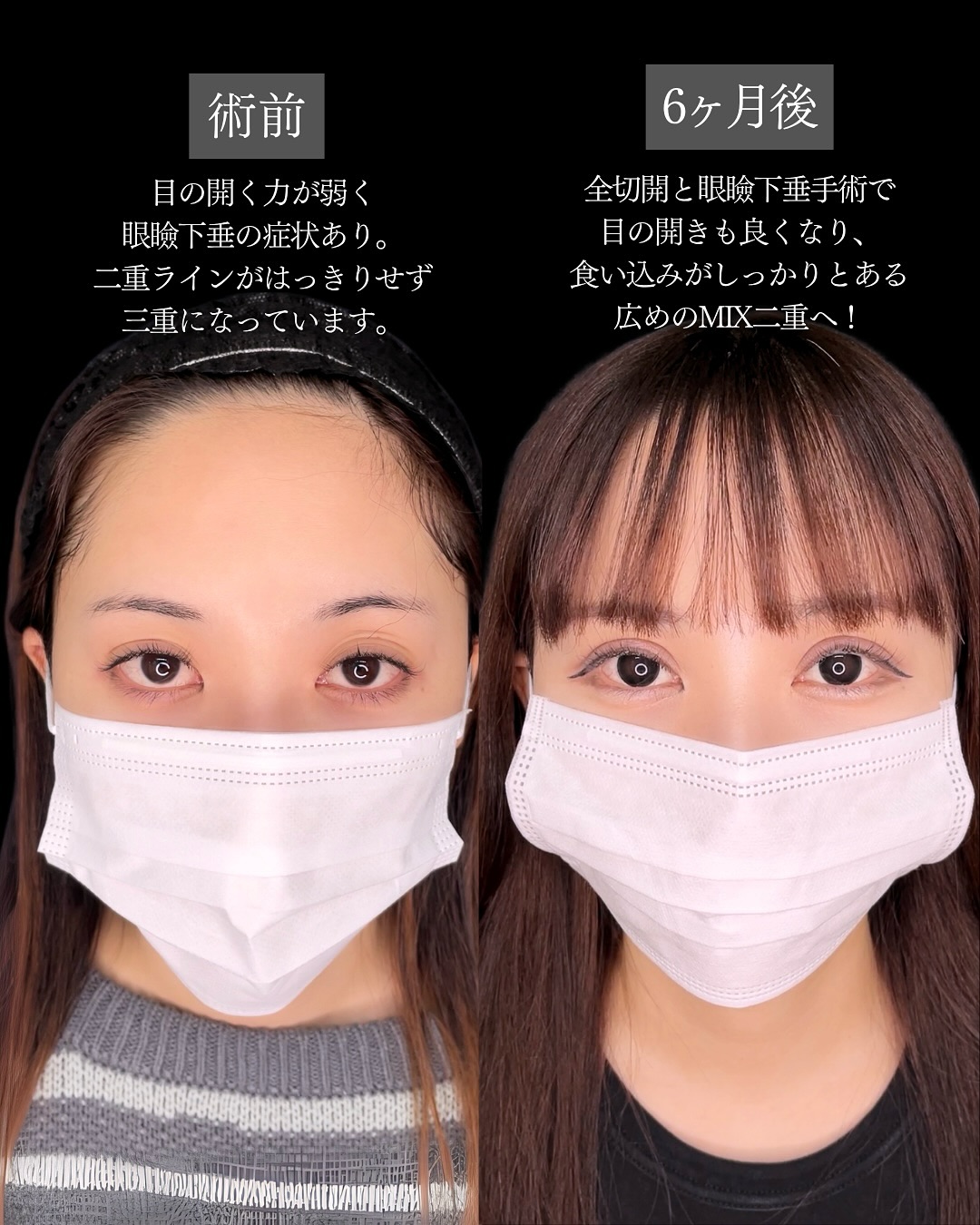 新宿院で行った二重整形で有名な吉原伯医師のMD式のたるみ取り併用全切開法二重術と眼瞼下垂手術の6ヶ月後の症例写真