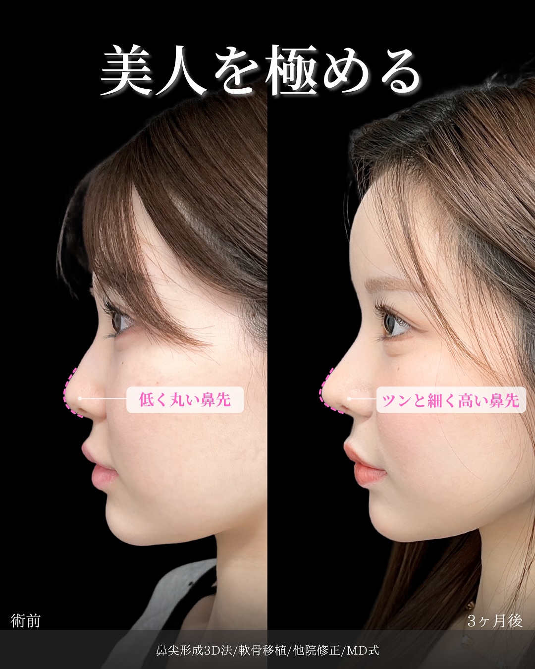 新宿院で行った鼻整形の名医の吉原伯医師のMD式の鼻尖形成3D法と軟骨移植と他院修正の症例写真