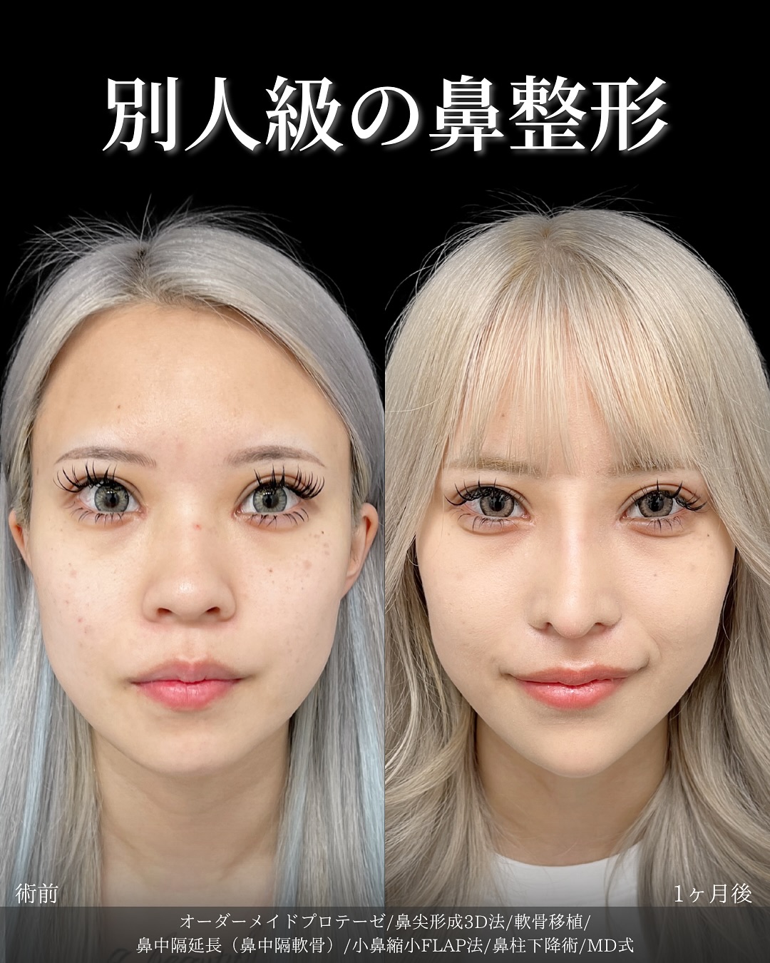 新宿院で行ったMD式のオーダーメイドプロテーゼと鼻尖形成3D法と軟骨移植と鼻中隔延長(鼻中隔軟骨)と小鼻縮小FLAP法と鼻柱下降術の名医の吉原伯医師の症例写真