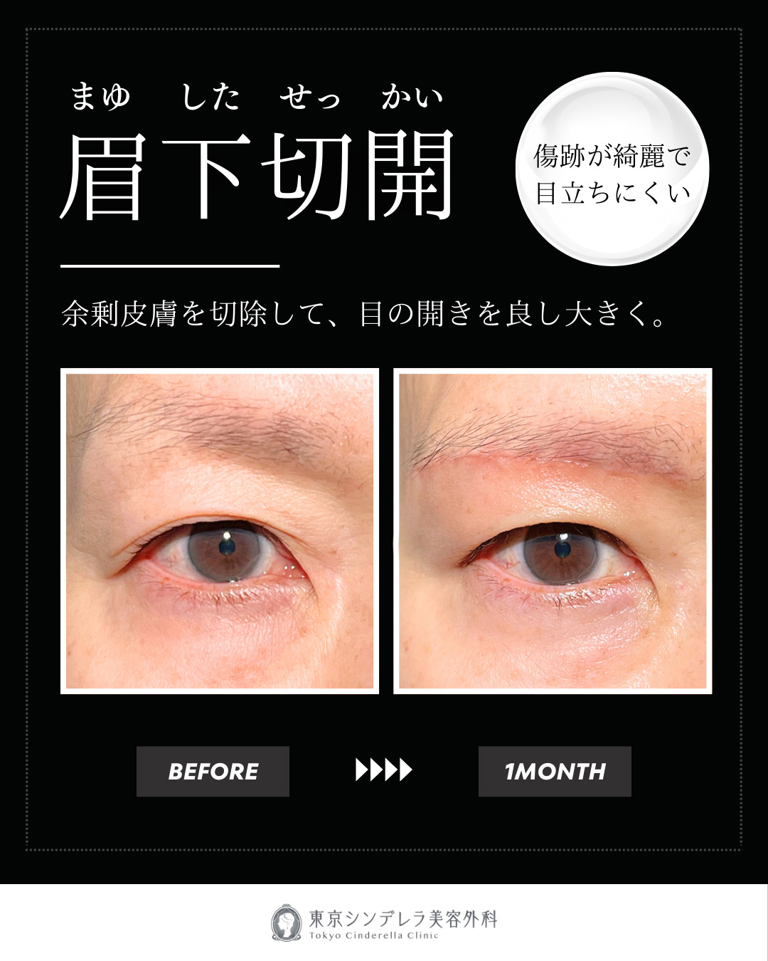 大宮院で行った二重整形の竹田昌平医師の症例写真