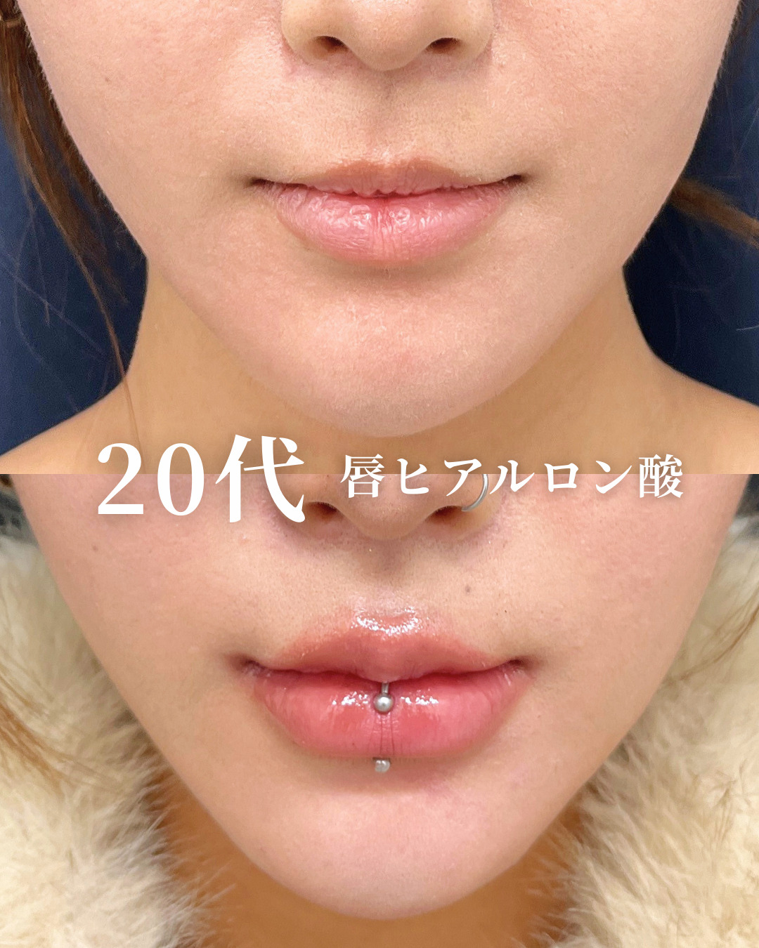大宮院で行った唇ヒアルロン酸の竹田昌平医師の症例写真