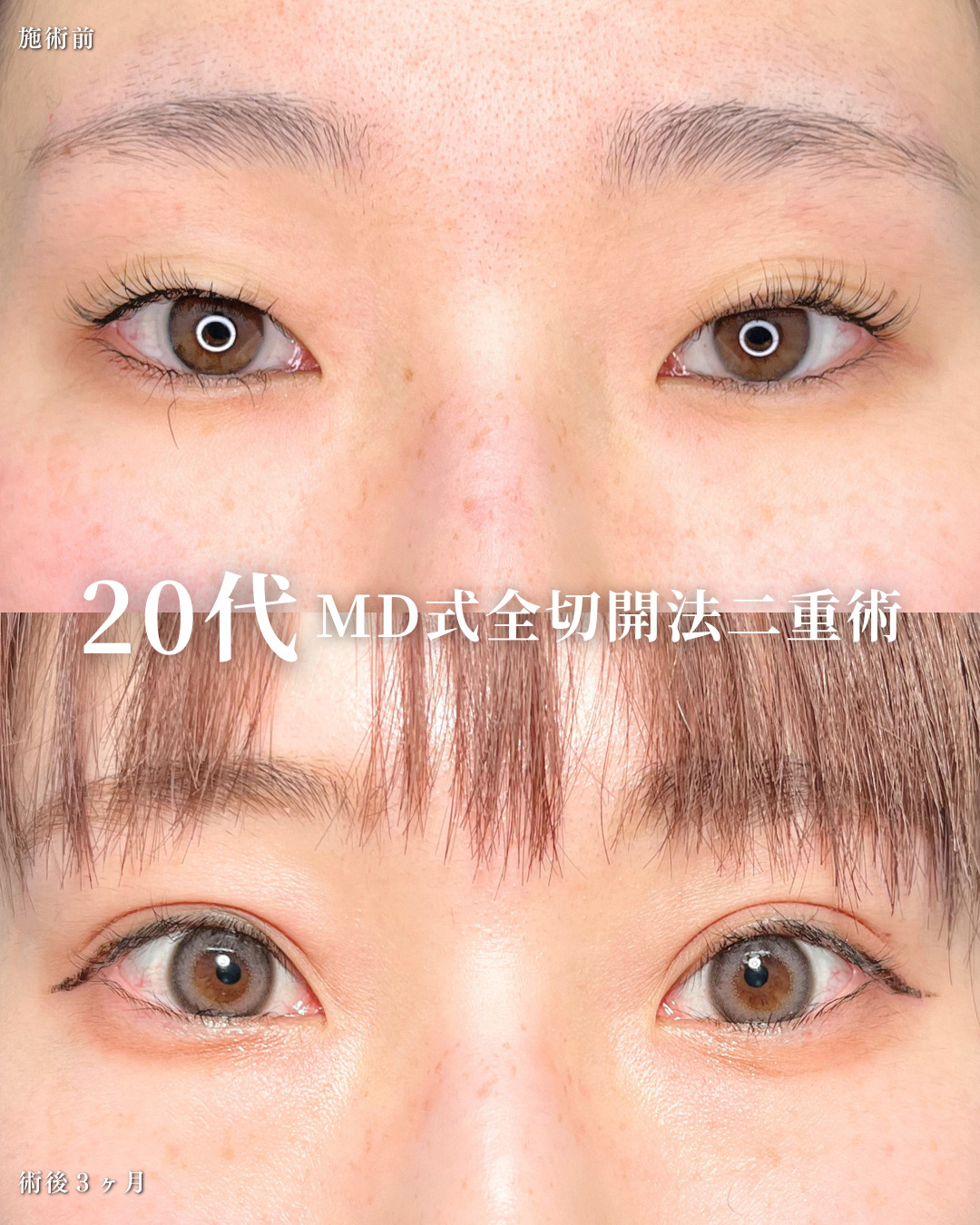 大宮院で行った二重整形の竹田昌平医師の症例写真
