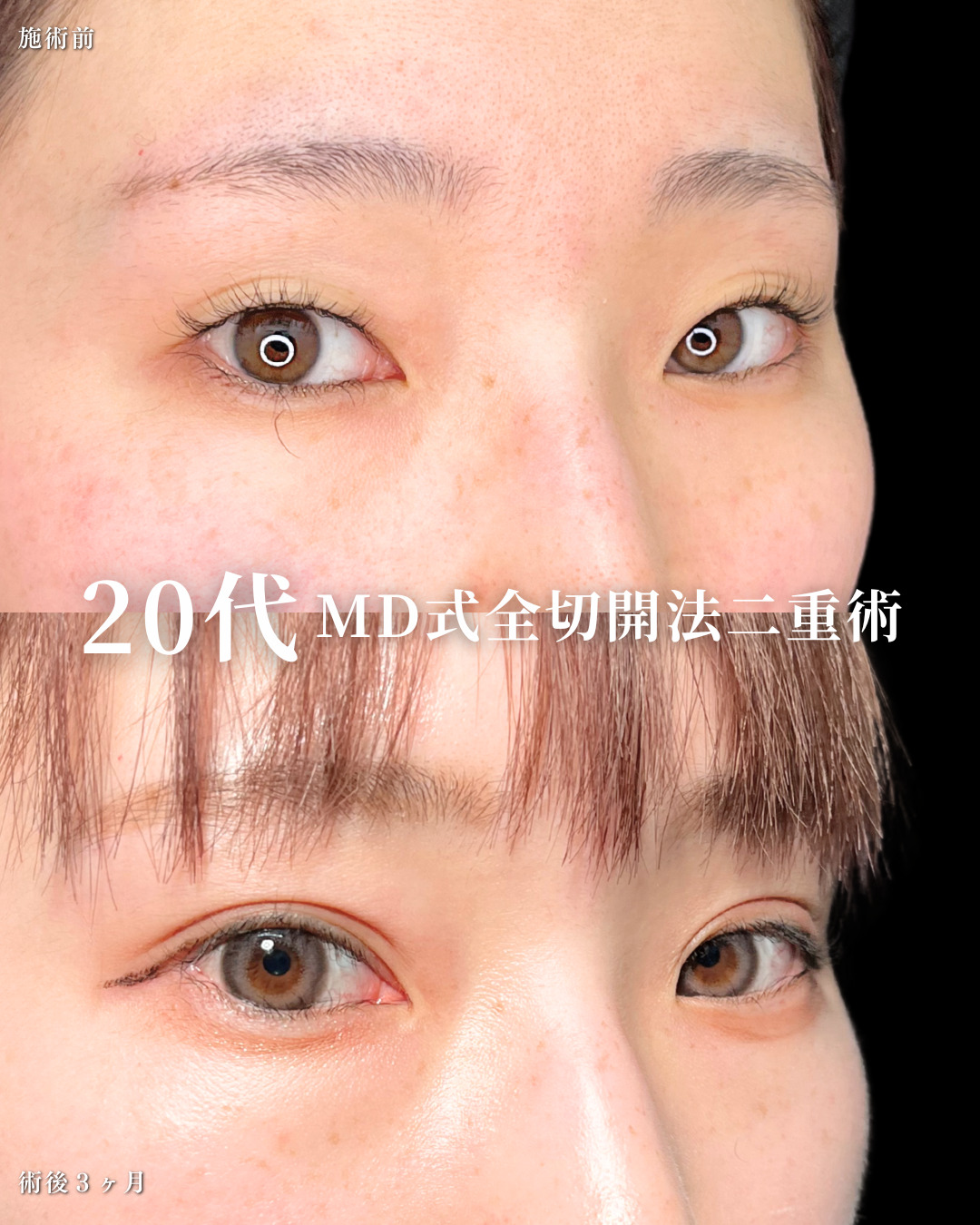 大宮院で行った二重整形の竹田昌平医師の症例写真