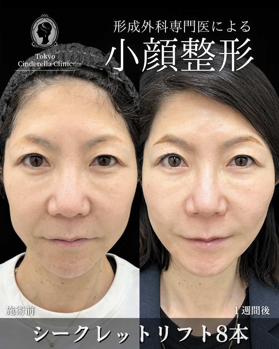 大宮院で行った小顔整形の竹田昌平医師の症例写真