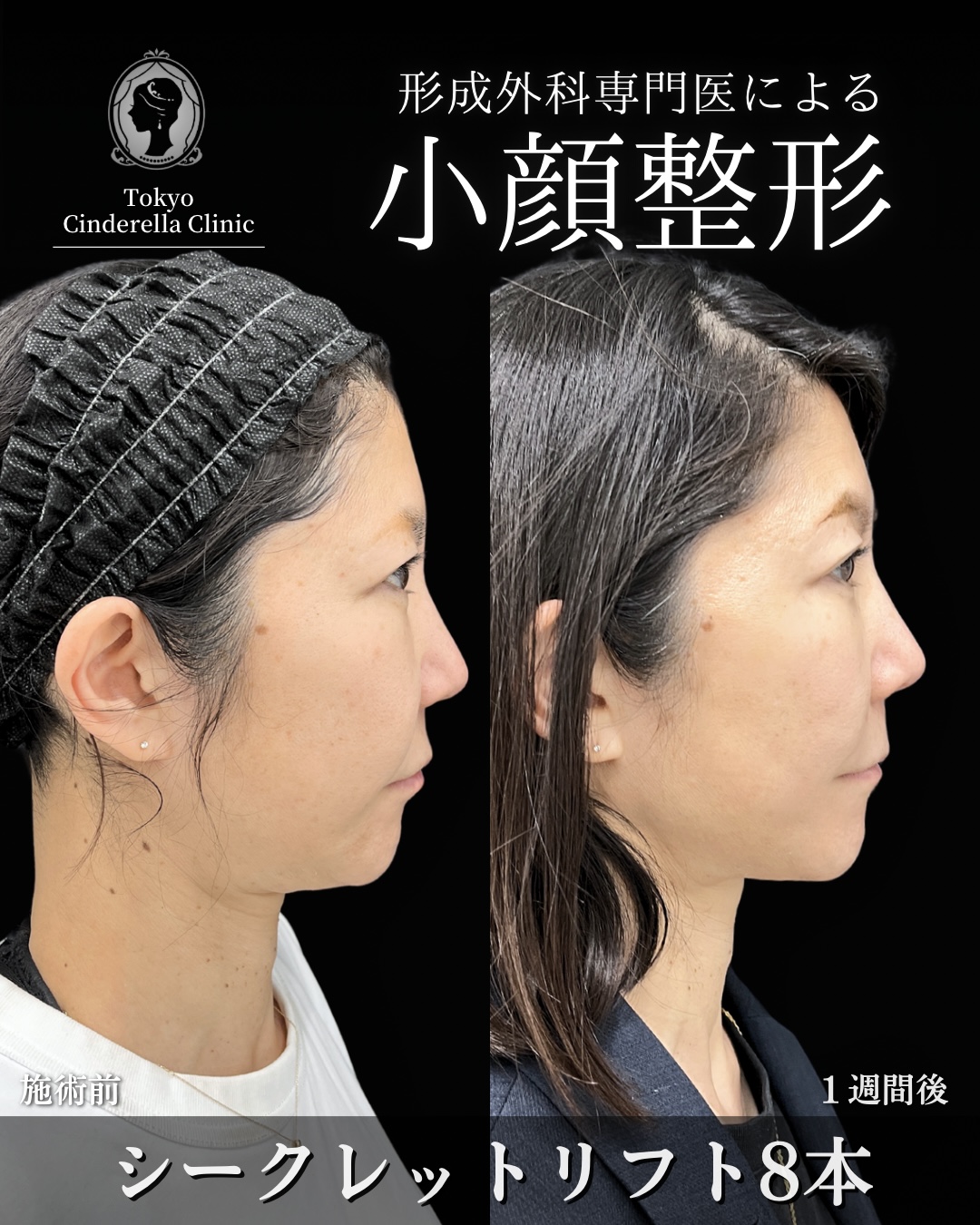 大宮院で行った小顔整形の竹田昌平医師の症例写真