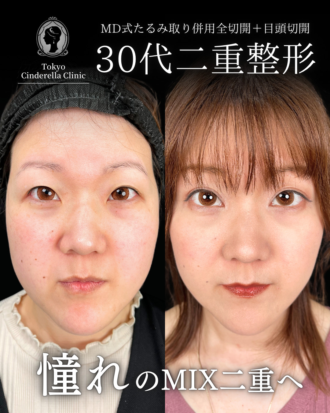 大宮院で行った二重整形の竹田昌平医師の症例写真