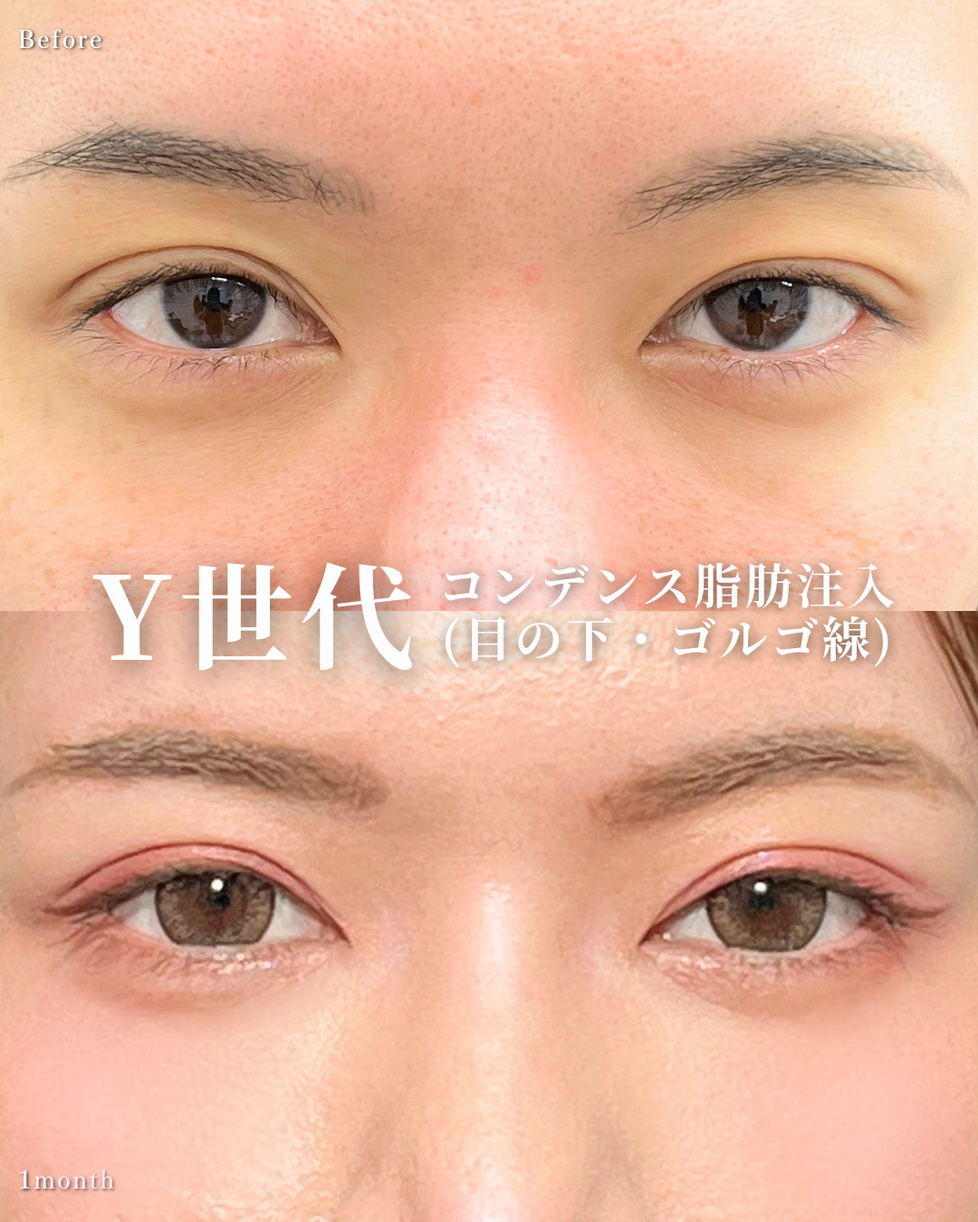 大宮院で行った脂肪注入の竹田昌平医師の症例写真