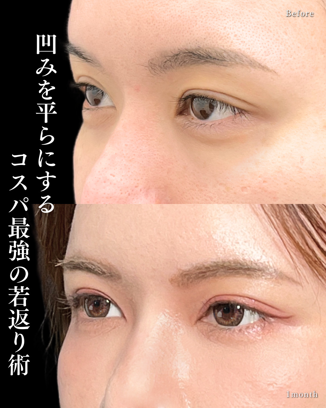 大宮院で行った脂肪注入の竹田昌平医師の症例写真
