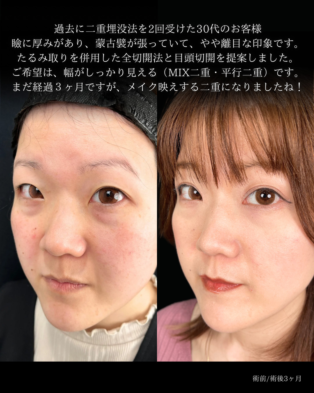 大宮院で行った二重整形の竹田昌平医師の症例写真