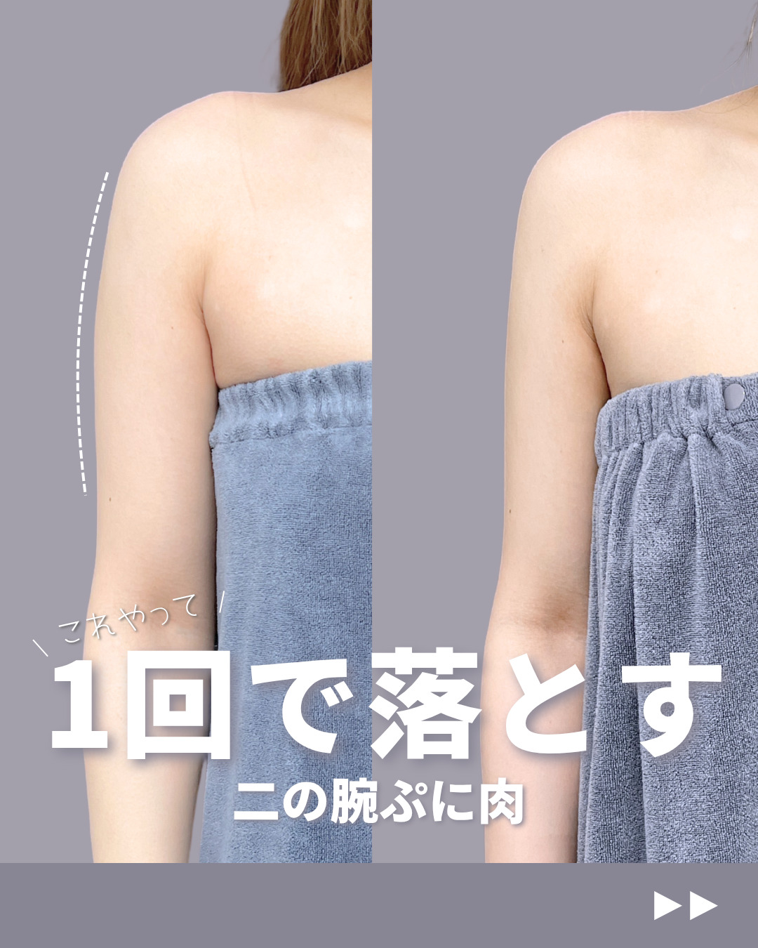 新宿院で行ったアキーセル脂肪吸引(二の腕・肩)の名医の吉原伯医師の症例写真