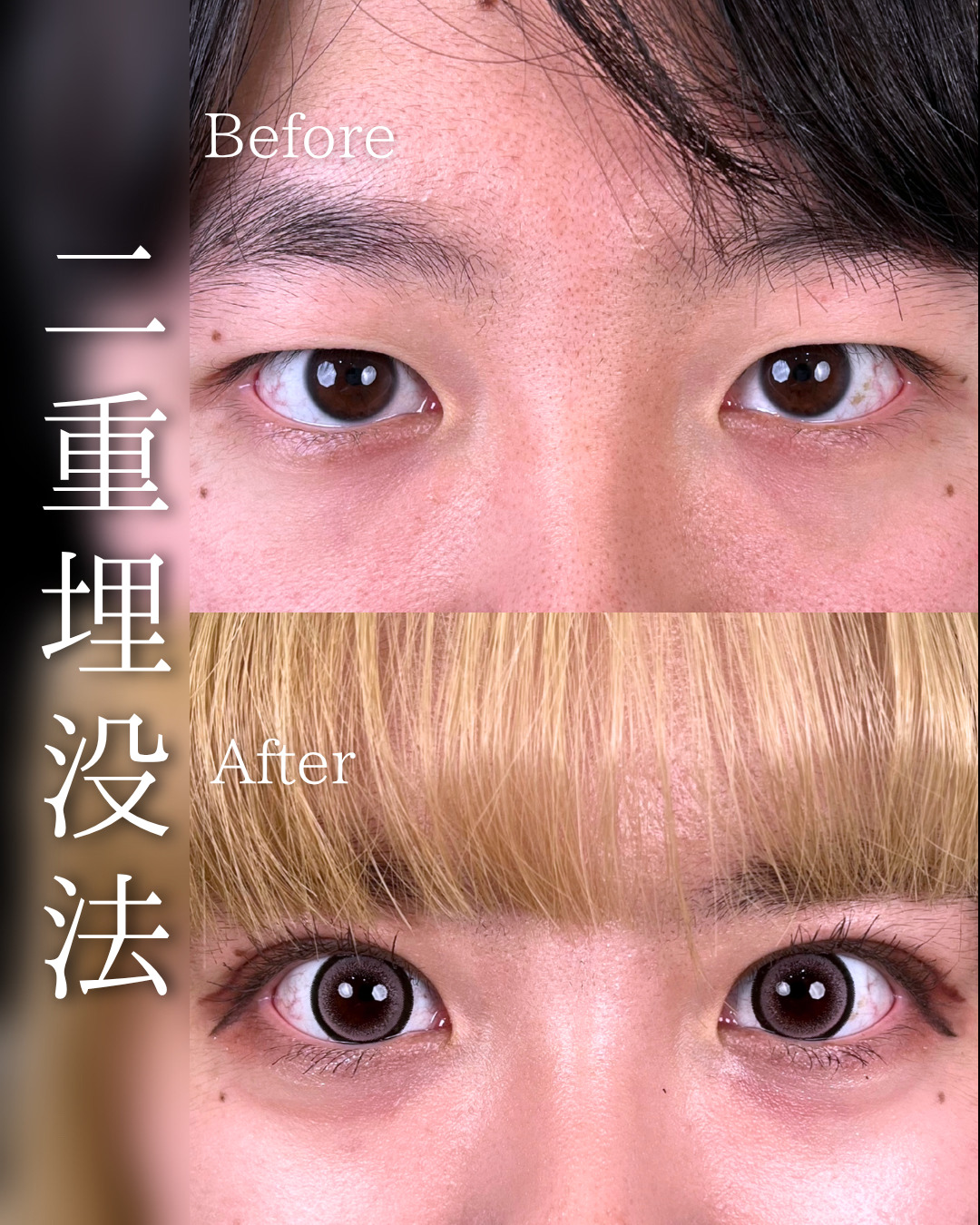 池袋院で行った二重整形の石井達也医師の症例写真