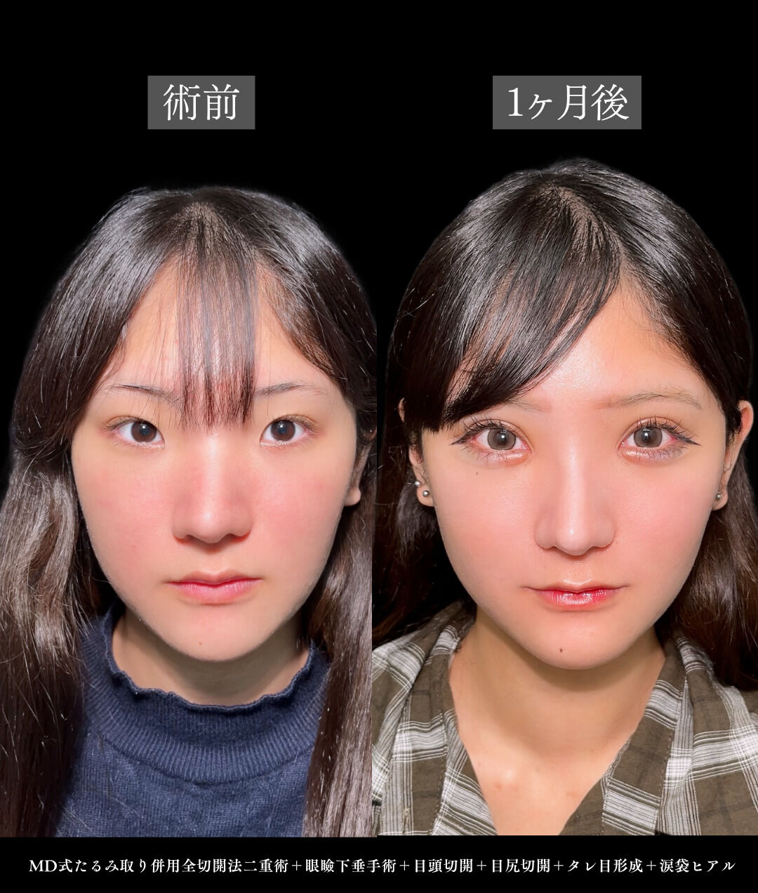 二重切開と眼瞼下垂と目頭切開と目尻切開と涙袋ヒアルで4方向拡大した１ヶ月の変化