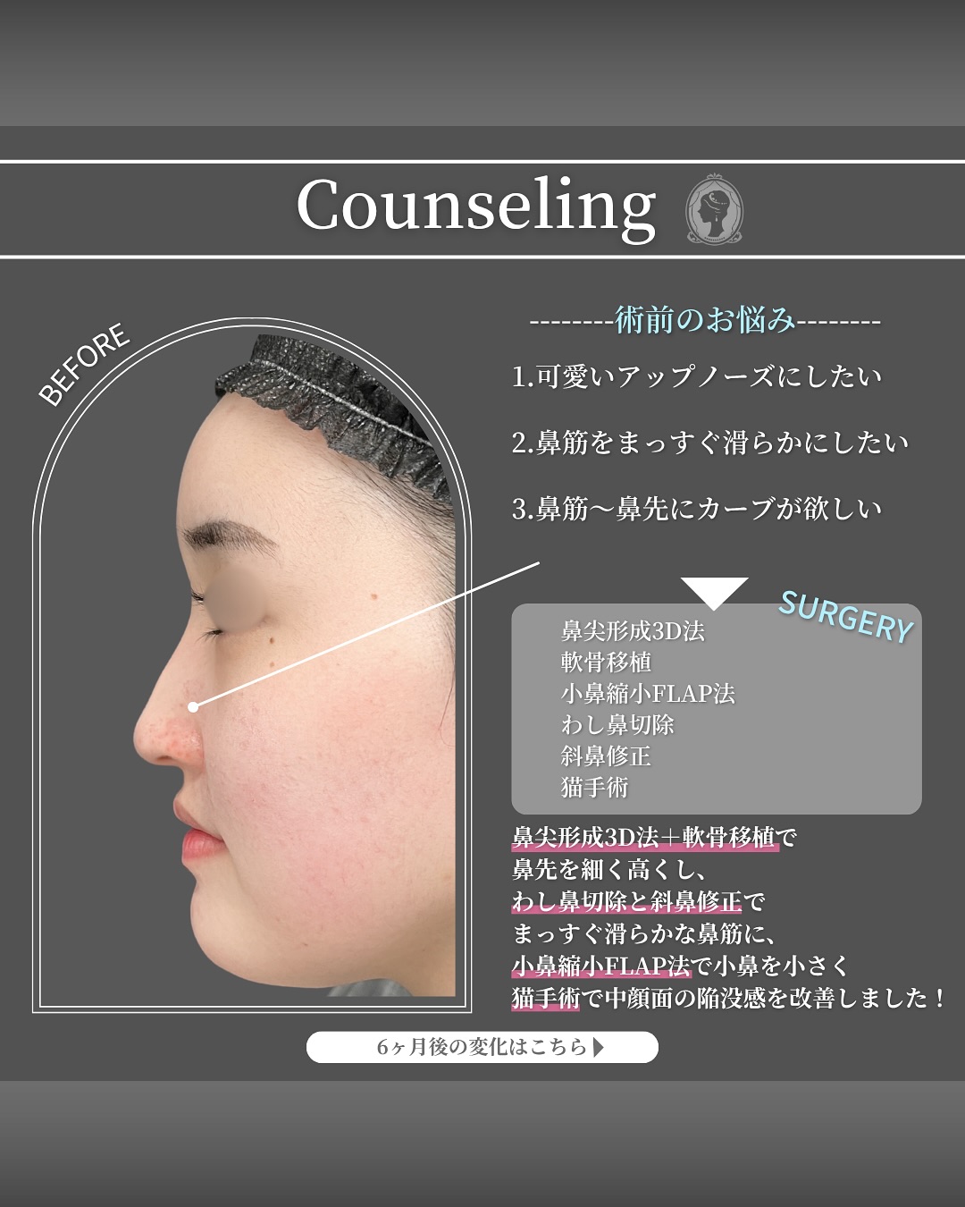 新宿院で行った鼻整形の名医の吉原伯医師のMD式の鼻尖形成3D法と軟骨移植とわし鼻切除と斜鼻修正と小鼻縮小FLAP法と猫手術の症例写真