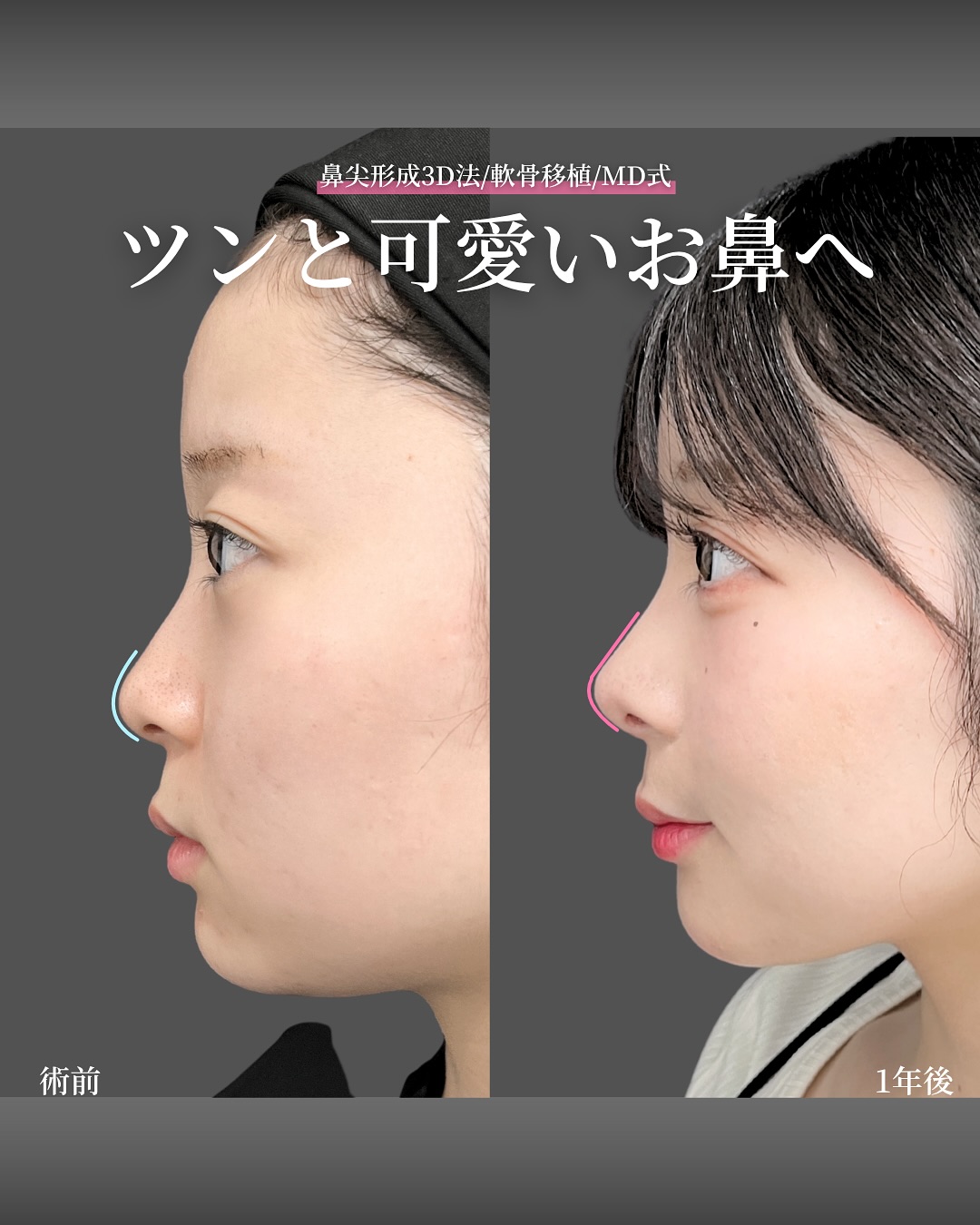 新宿院で行った鼻整形の名医の吉原伯医師のMD式の鼻尖形成3D法と軟骨移植の症例写真