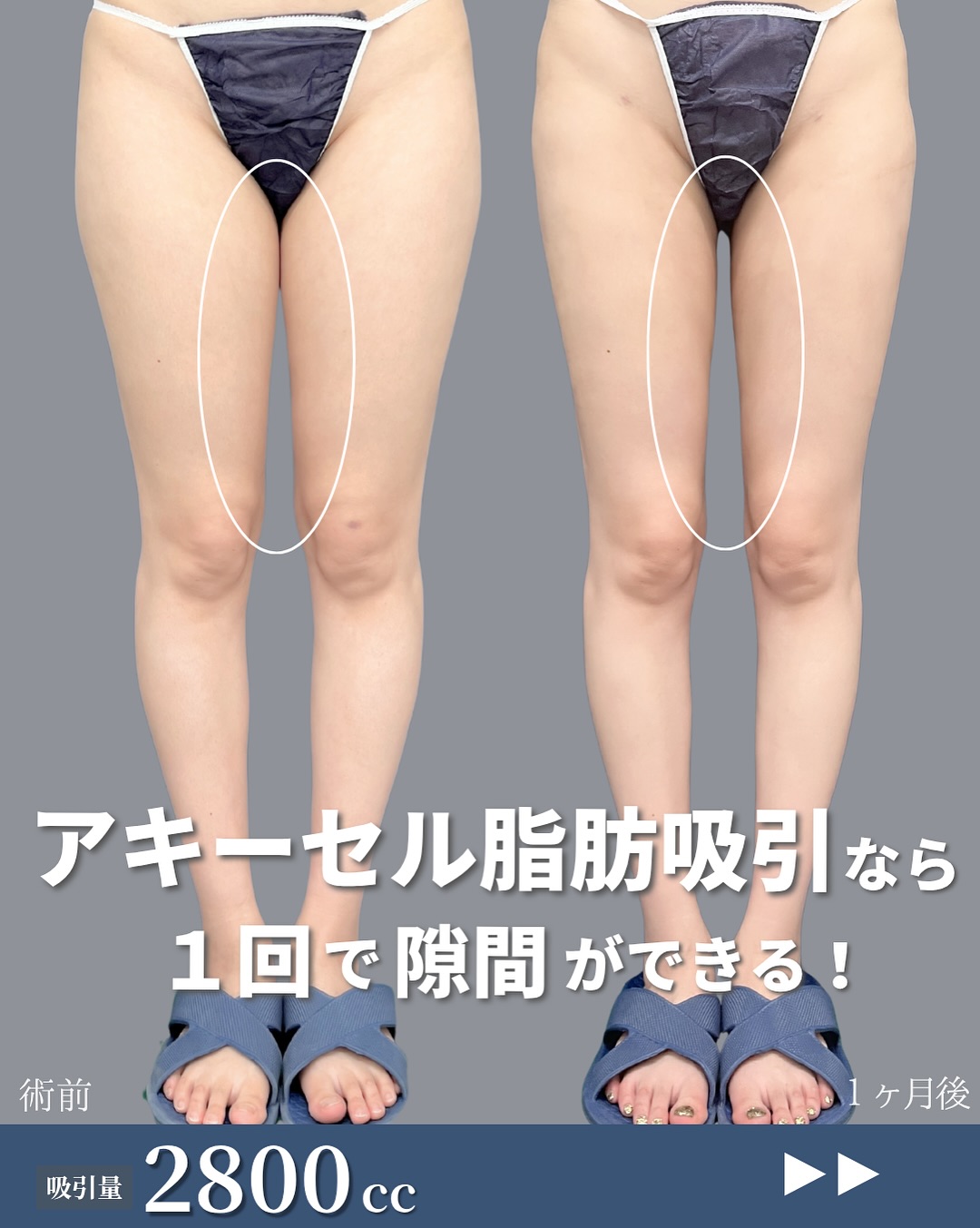 新宿院で行ったアキーセル脂肪吸引(太もも全周・お尻・膝)の名医の吉原伯医師の症例写真